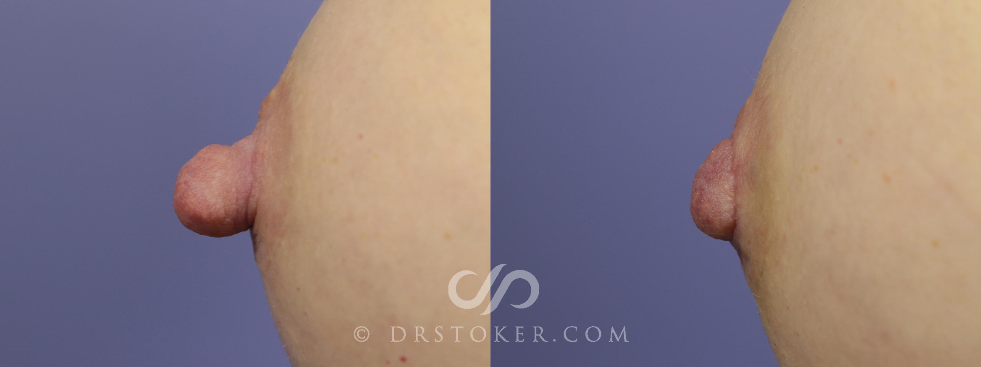 Before & After Nipple - Reduction Case 1206 View #1 View in Los Angeles, CA