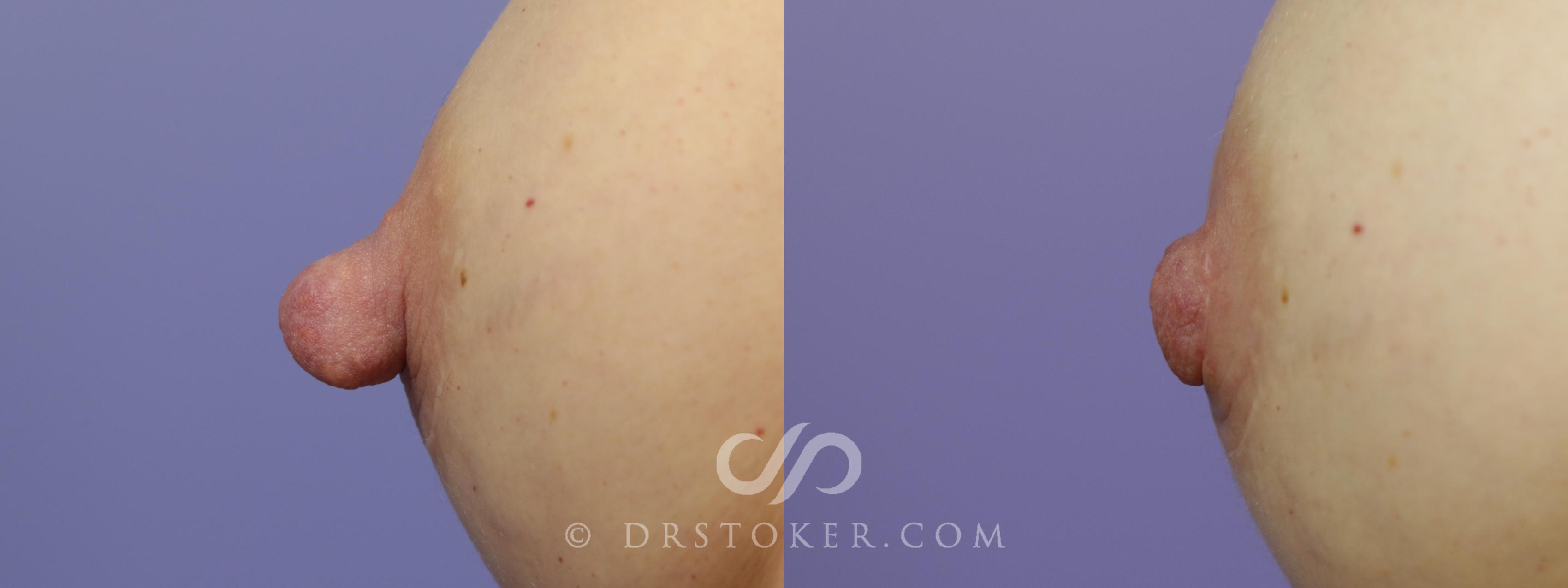 Before & After Nipple - Reduction Case 1213 View #1 View in Los Angeles, CA