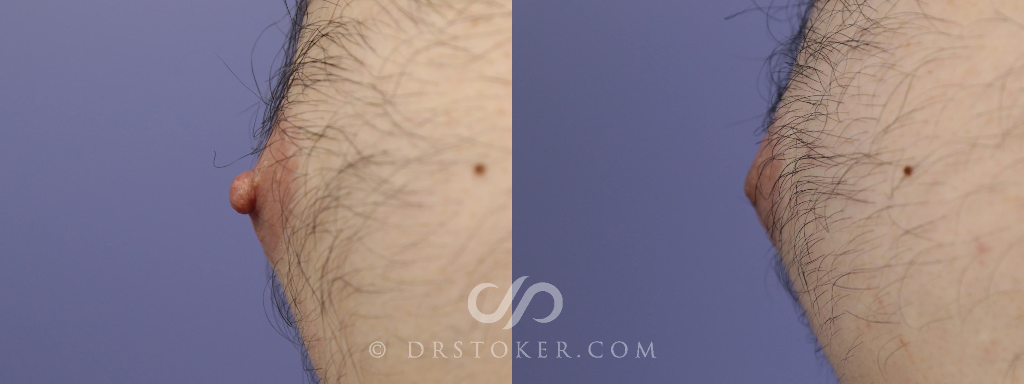 Before & After Nipple Reduction Case 1229 View #1 View in Los Angeles, CA
