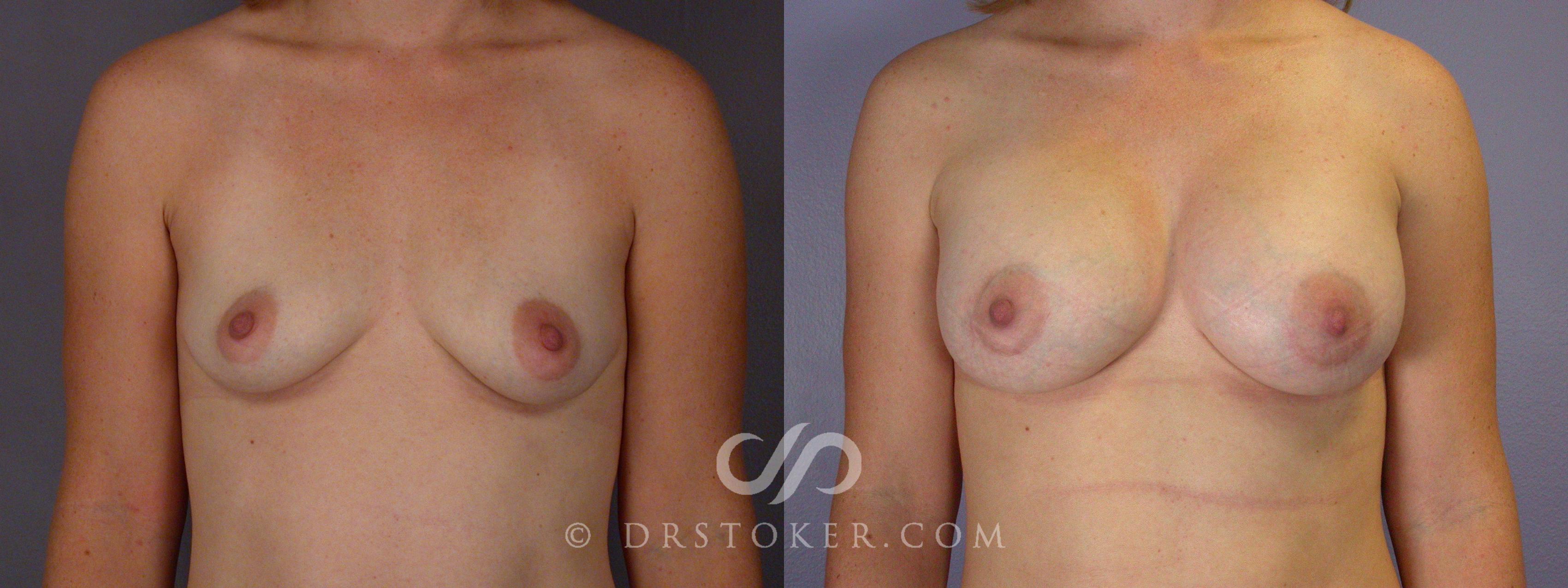 Before & After Breast Asymmetry Correction Case 452 View #1 View in Los Angeles, CA
