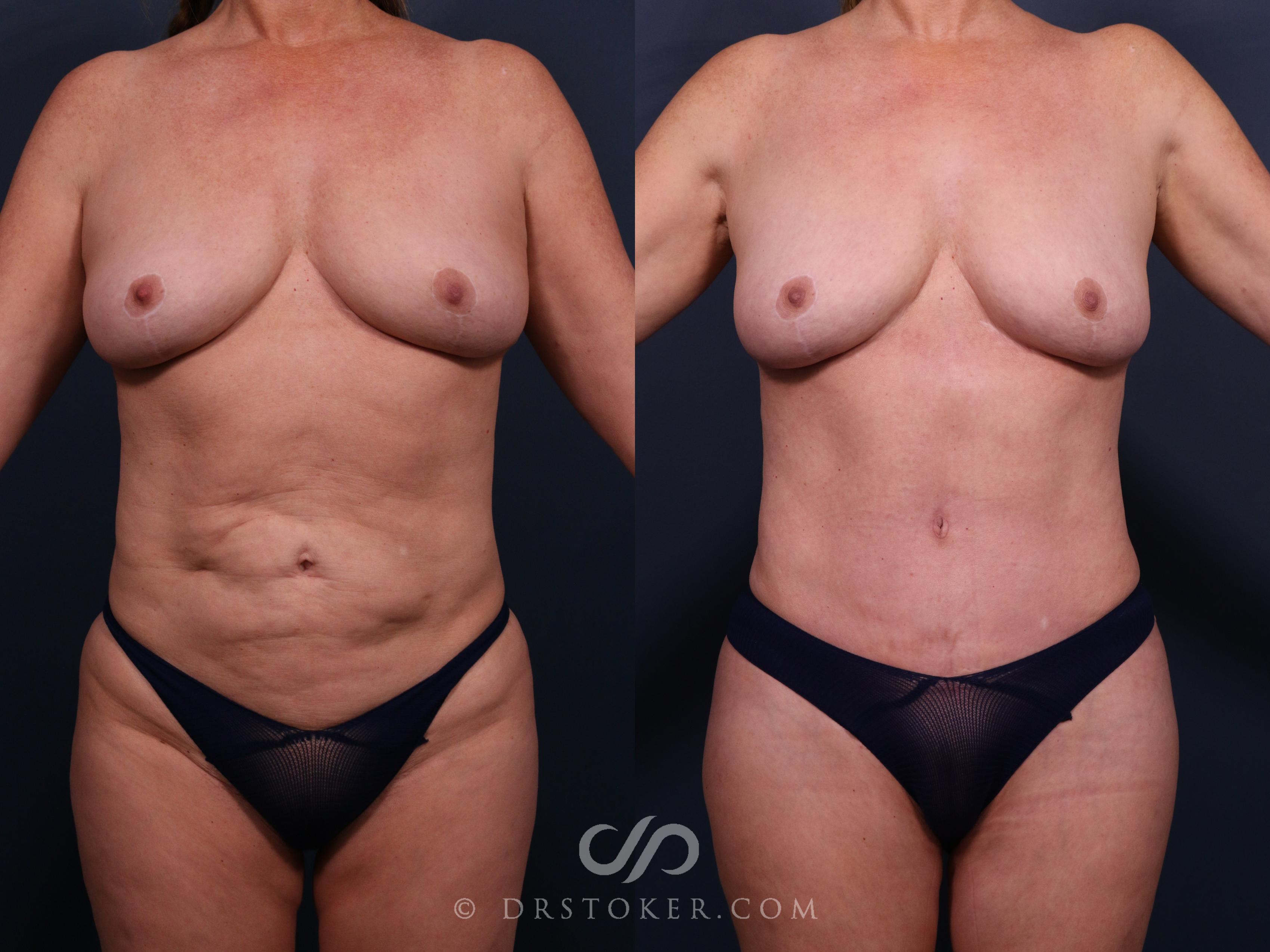 Before & After Revision Tummy Tuck Case 2472 Front View in Los Angeles, CA