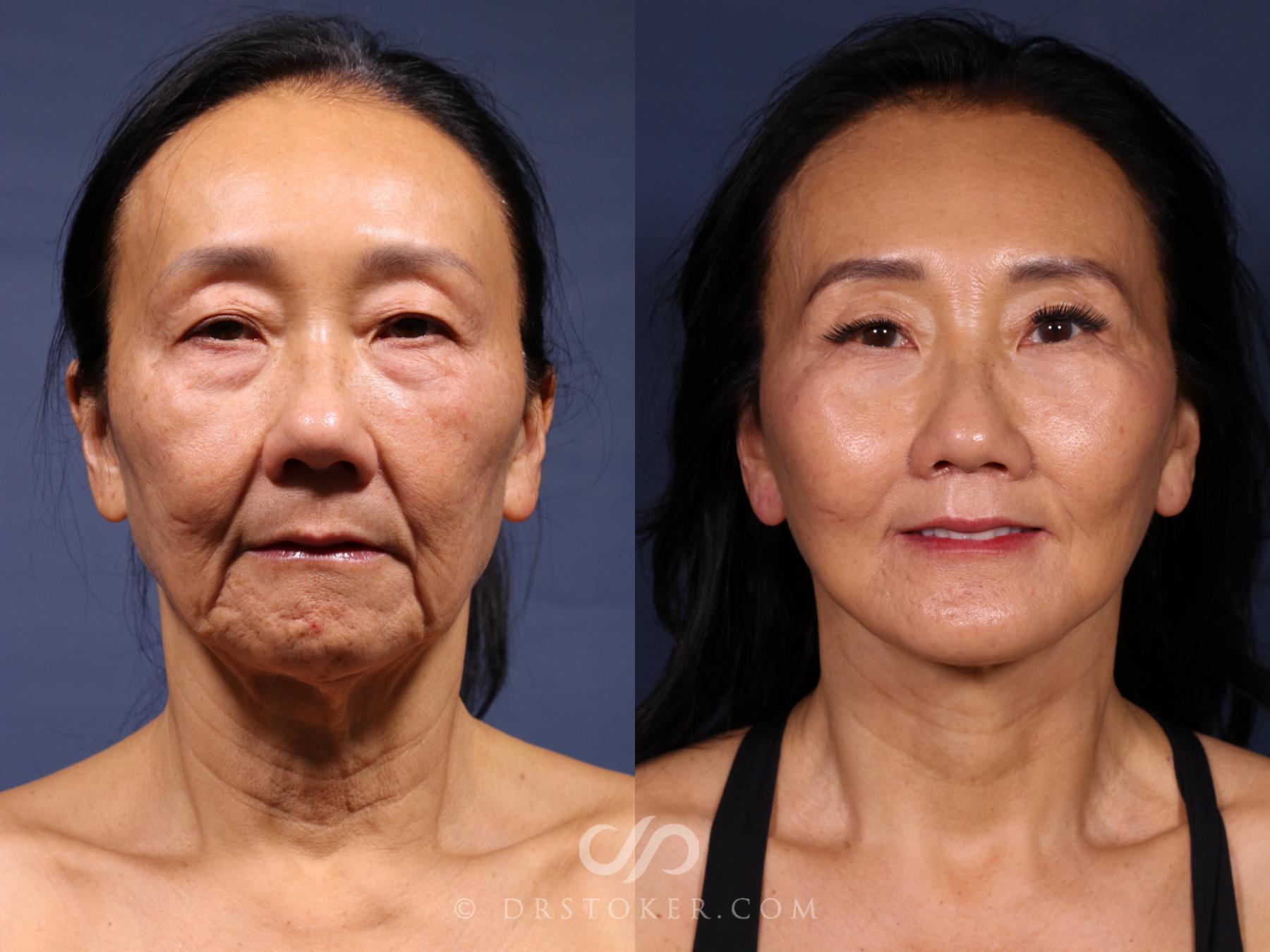 Before & After Asian Plastic Surgery Case 2621 Front View in Los Angeles, CA