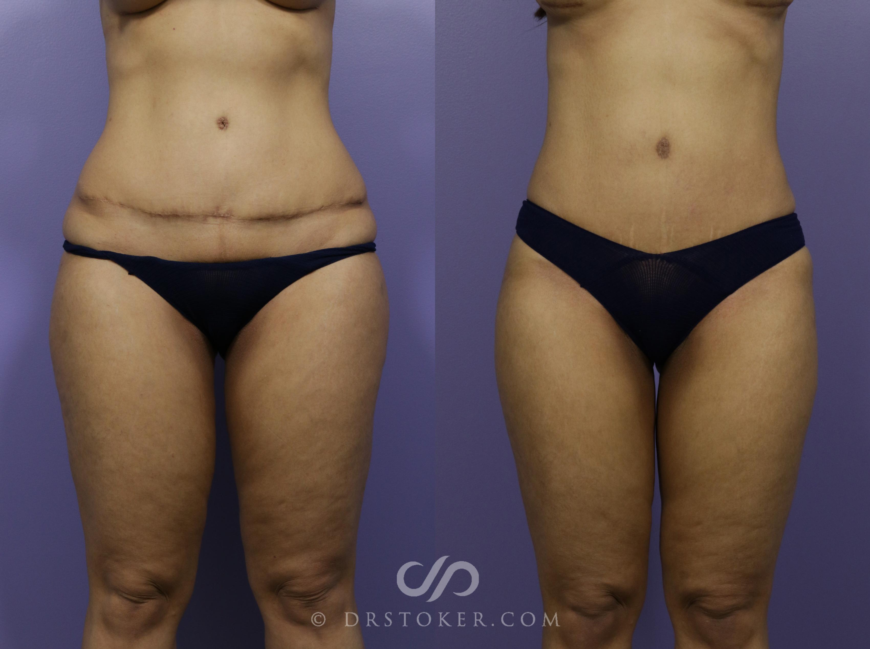 Before & After Tummy Tuck Case 1186 View #1 View in Los Angeles, CA