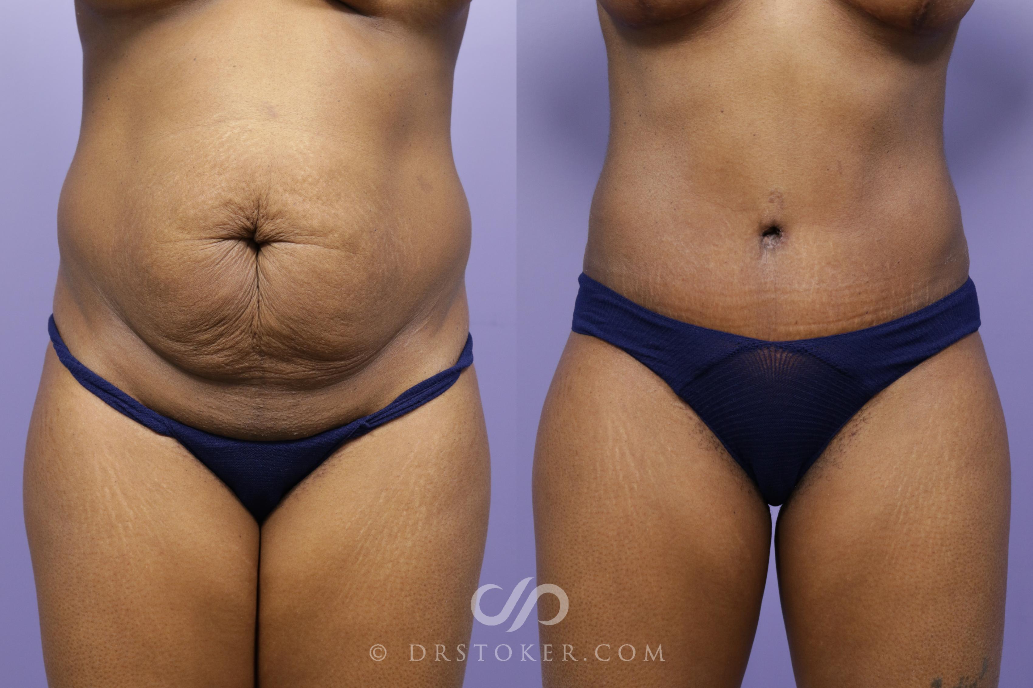 Before & After Tummy Tuck Case 1568 View #1 View in Los Angeles, CA