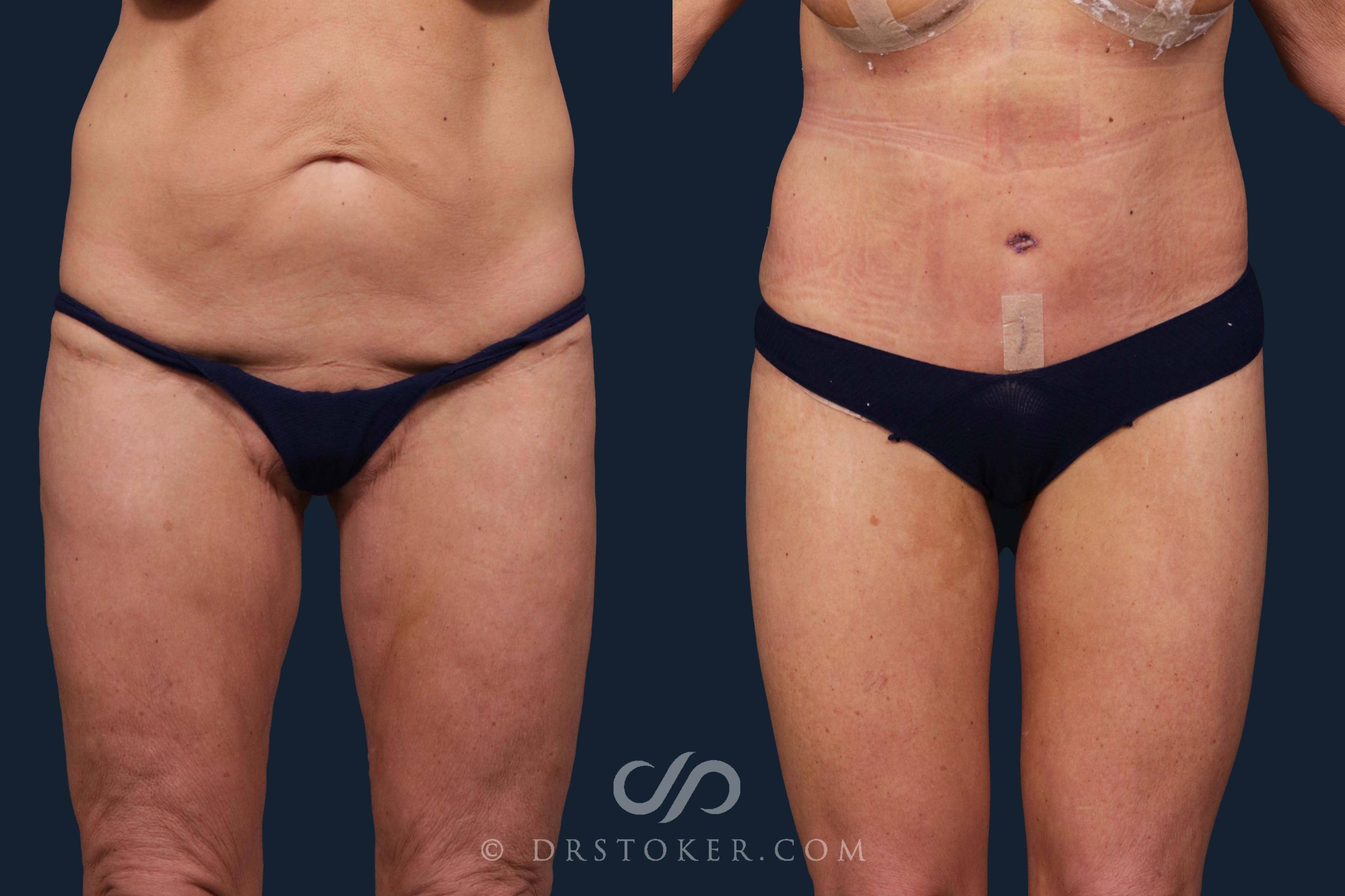 Before & After Revision Tummy Tuck Case 2469 Front View in Los Angeles, CA