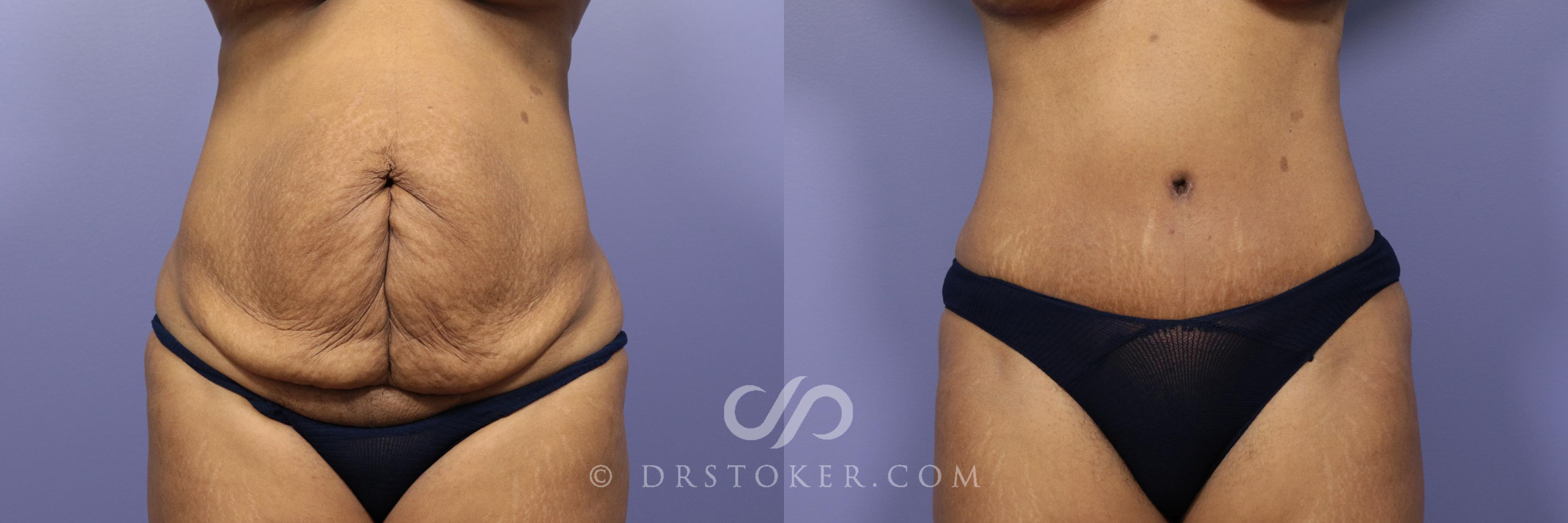 Before & After Tummy Tuck Case 763 View #1 View in Los Angeles, CA