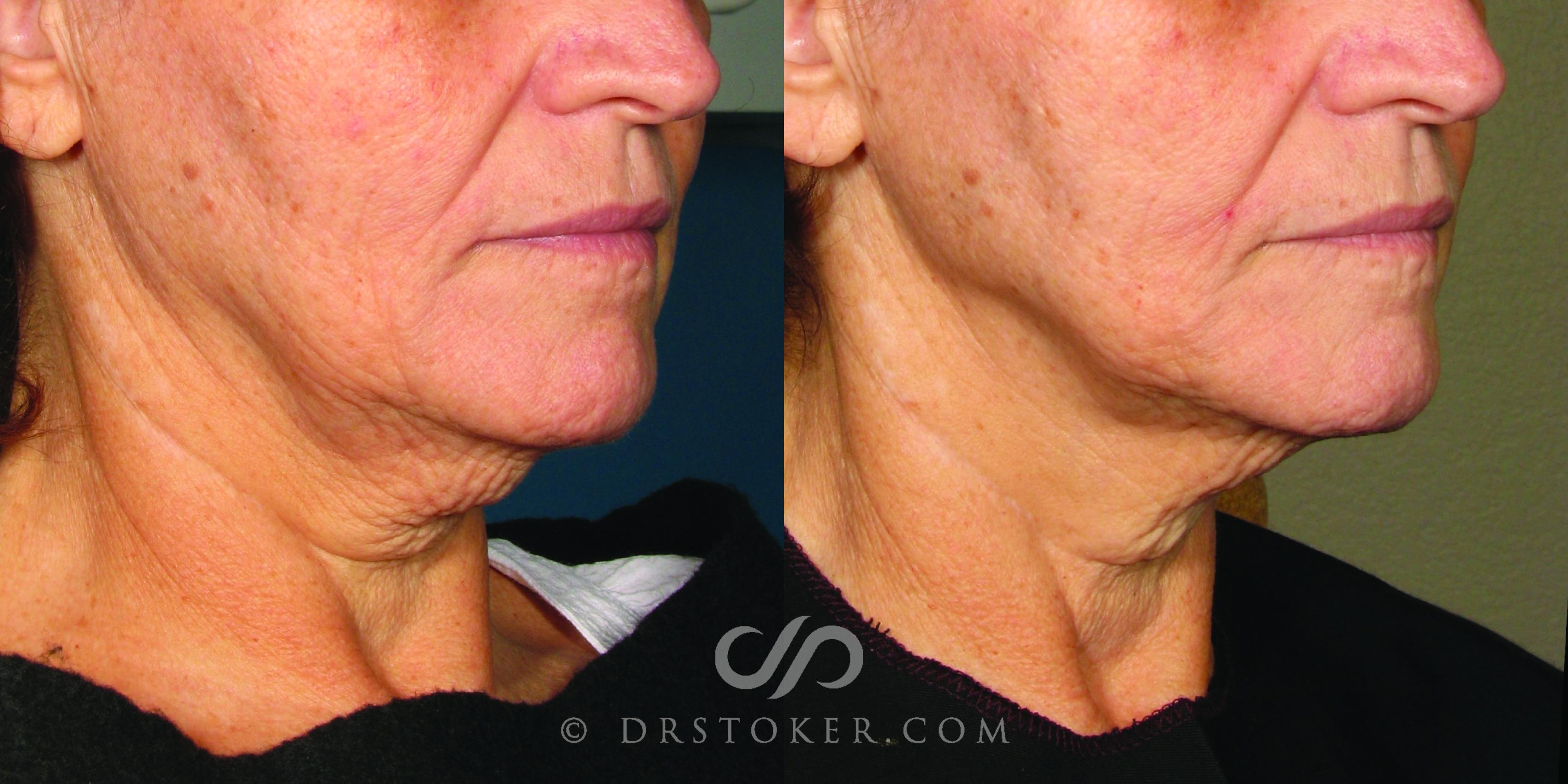 Before & After Ultherapy® Skin Tightening Case 1633 View #1 View in Los Angeles, CA