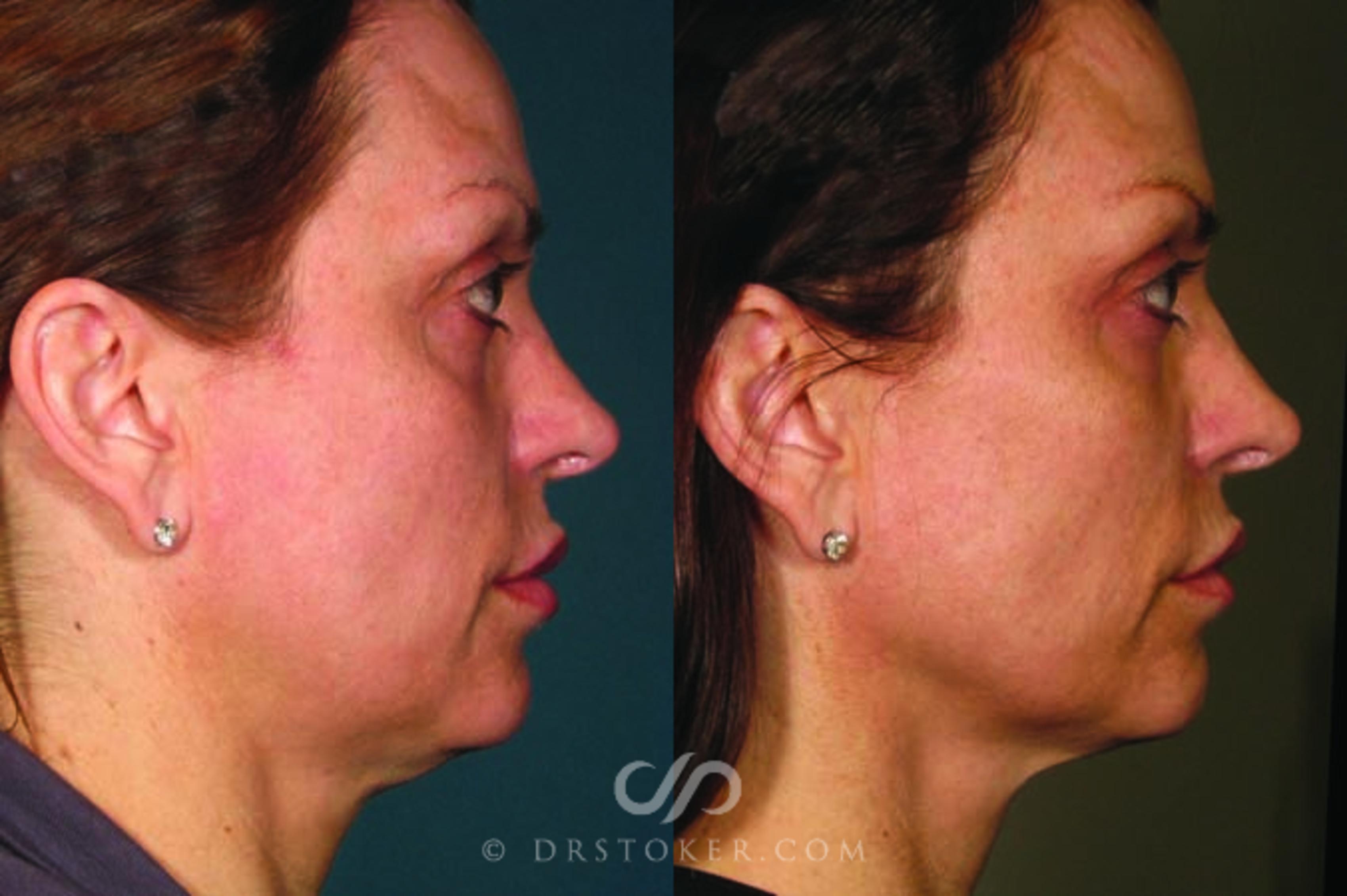 Before & After Ultherapy® Skin Tightening Case 1634 View #1 View in Los Angeles, CA