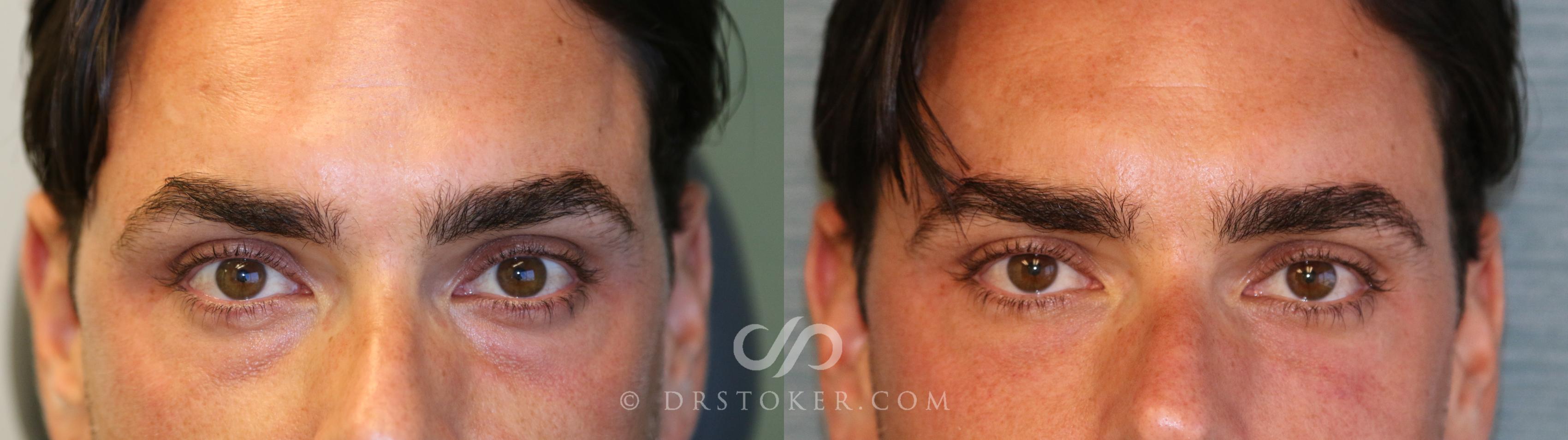 Before & After Facial Fillers Case 1596 View #1 View in Los Angeles, CA