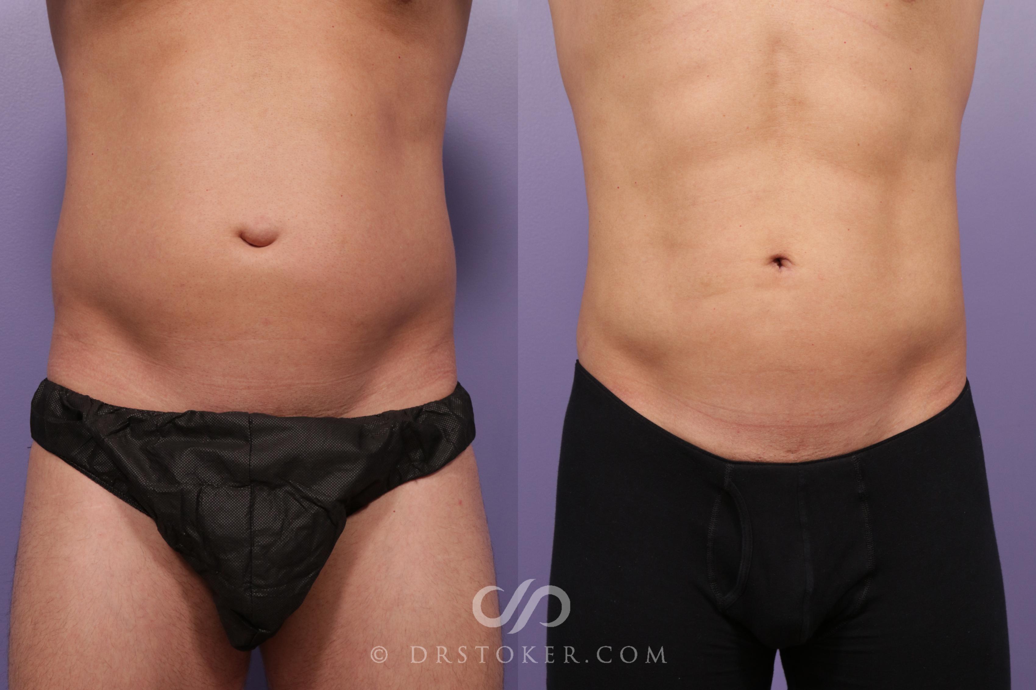 Before & After Abdominal Etching & Sculpting for Men Case 1699 View #1 View in Los Angeles, CA