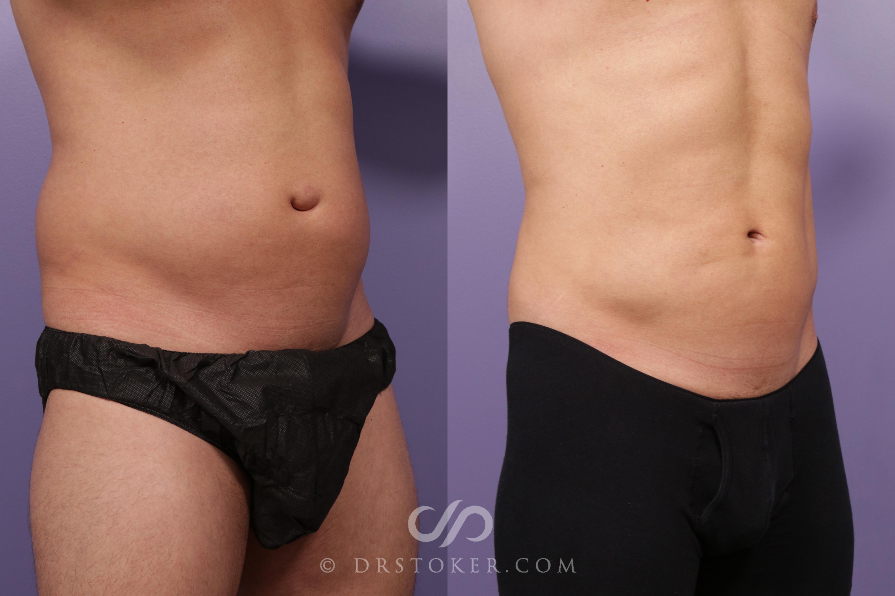 Before & After Abdominal Etching & Sculpting for Men Case 1701 View #1 View in Los Angeles, CA