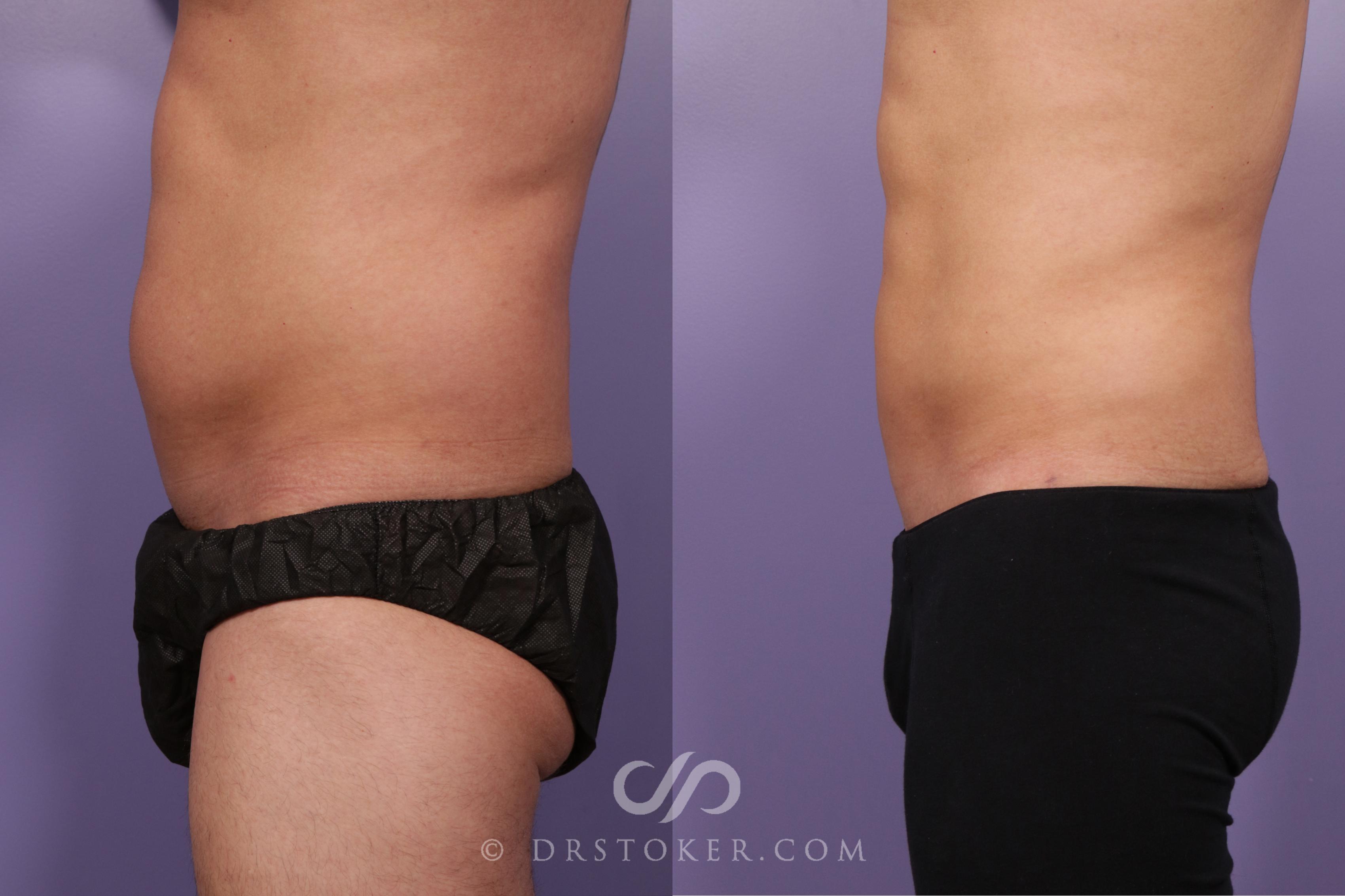 Before & After Liposuction - Abdominal Etching & Sculpting Case 1702 View #1 View in Los Angeles, CA