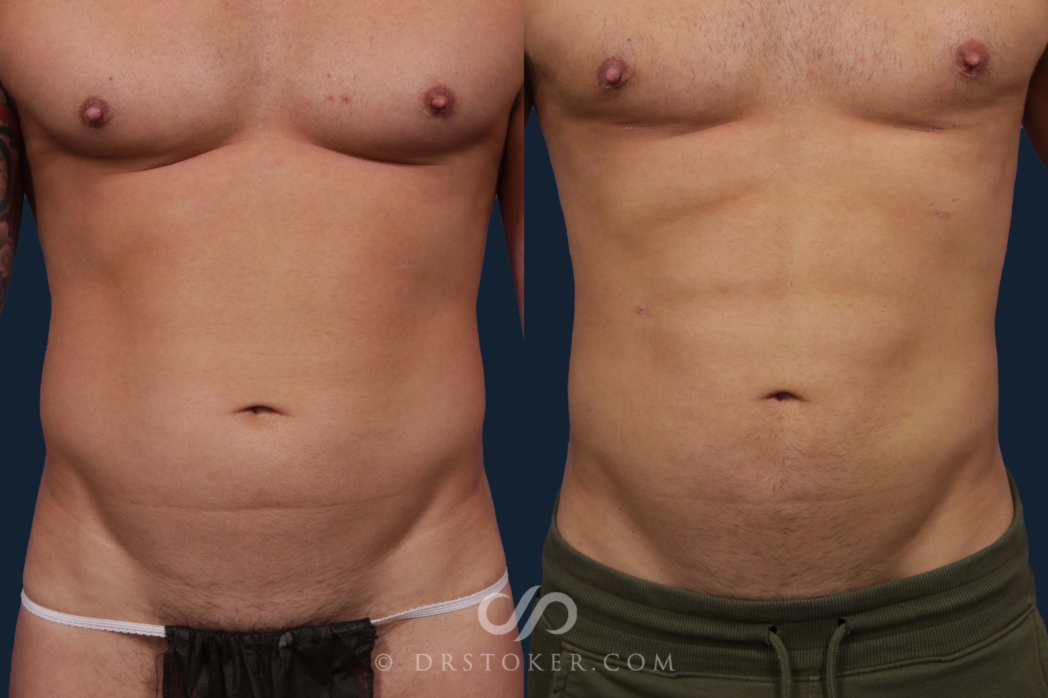 Before & After Abdominal Etching & Sculpting for Men Case 1888 Front View in Los Angeles, CA