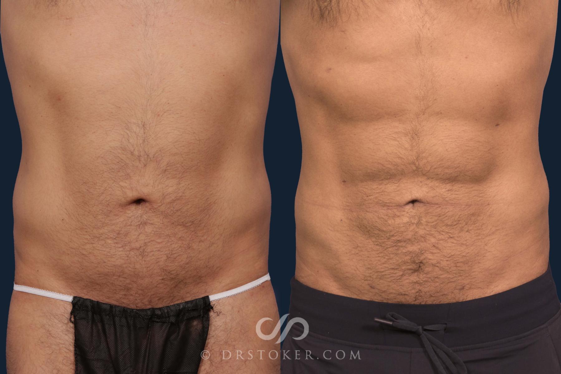 Before & After Abdominal Etching & Sculpting for Men Case 2045 Front View in Los Angeles, CA
