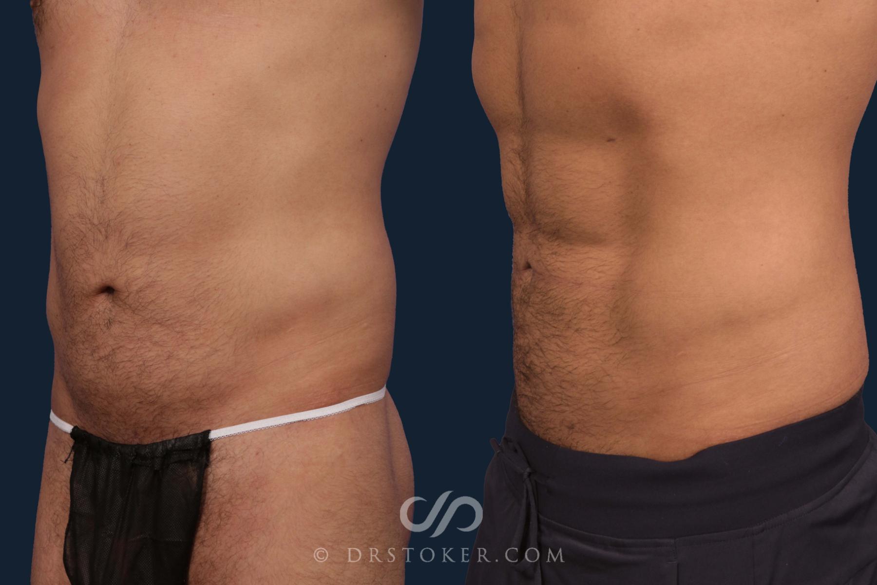 Before & After Abdominal Etching & Sculpting for Men Case 2045 Left Oblique View in Los Angeles, CA