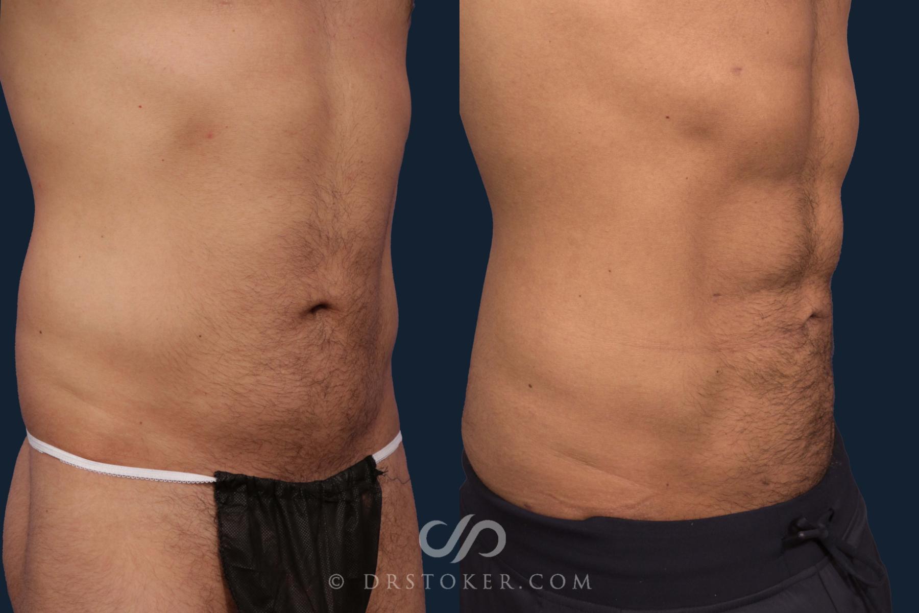 Before & After Abdominal Etching & Sculpting for Men Case 2045 Right Oblique View in Los Angeles, CA
