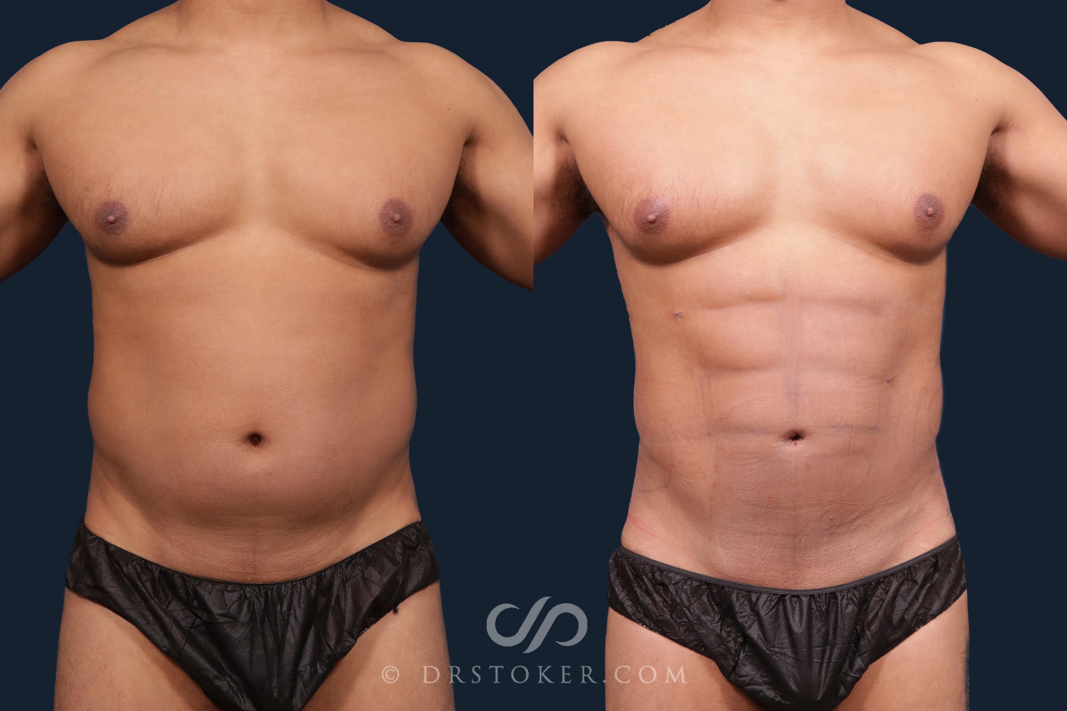 Before & After Abdominal Etching & Sculpting for Men Case 2145 Front View in Los Angeles, CA