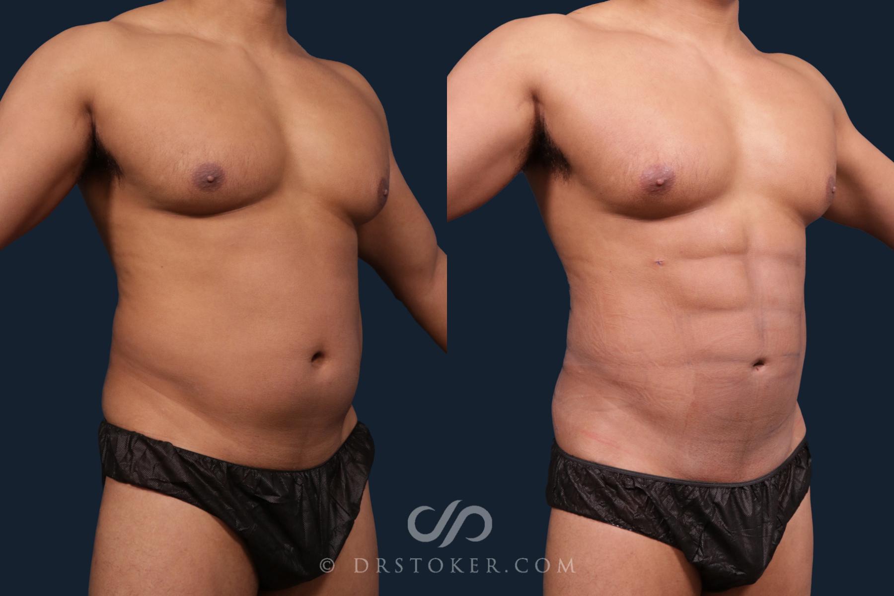 Before & After Liposuction for Men Case 2145 Right Oblique View in Los Angeles, CA
