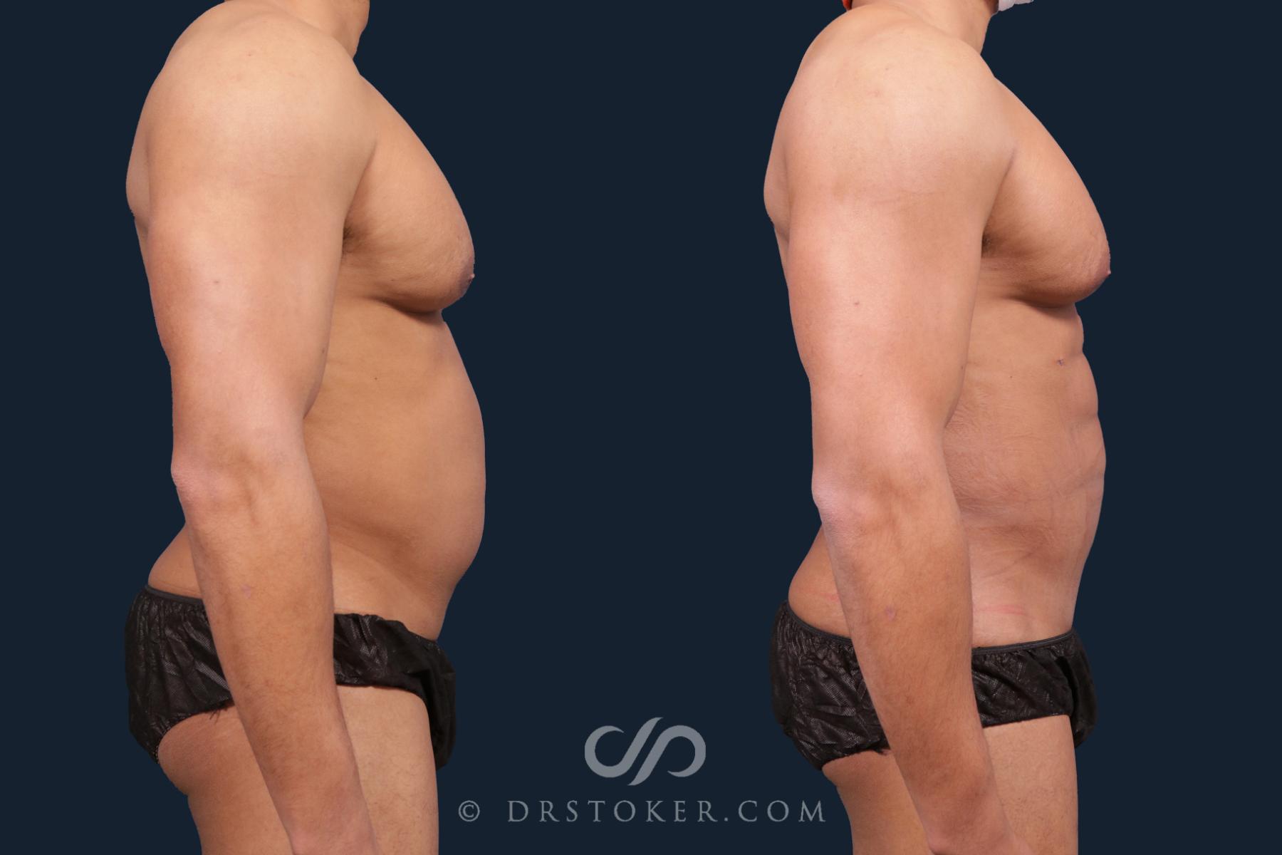 Before & After Abdominal Etching & Sculpting for Men Case 2145 Right Side View in Los Angeles, CA