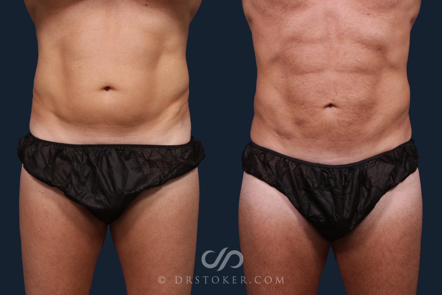 Before & After Abdominal Etching & Sculpting for Men Case 2179 Front View in Los Angeles, CA