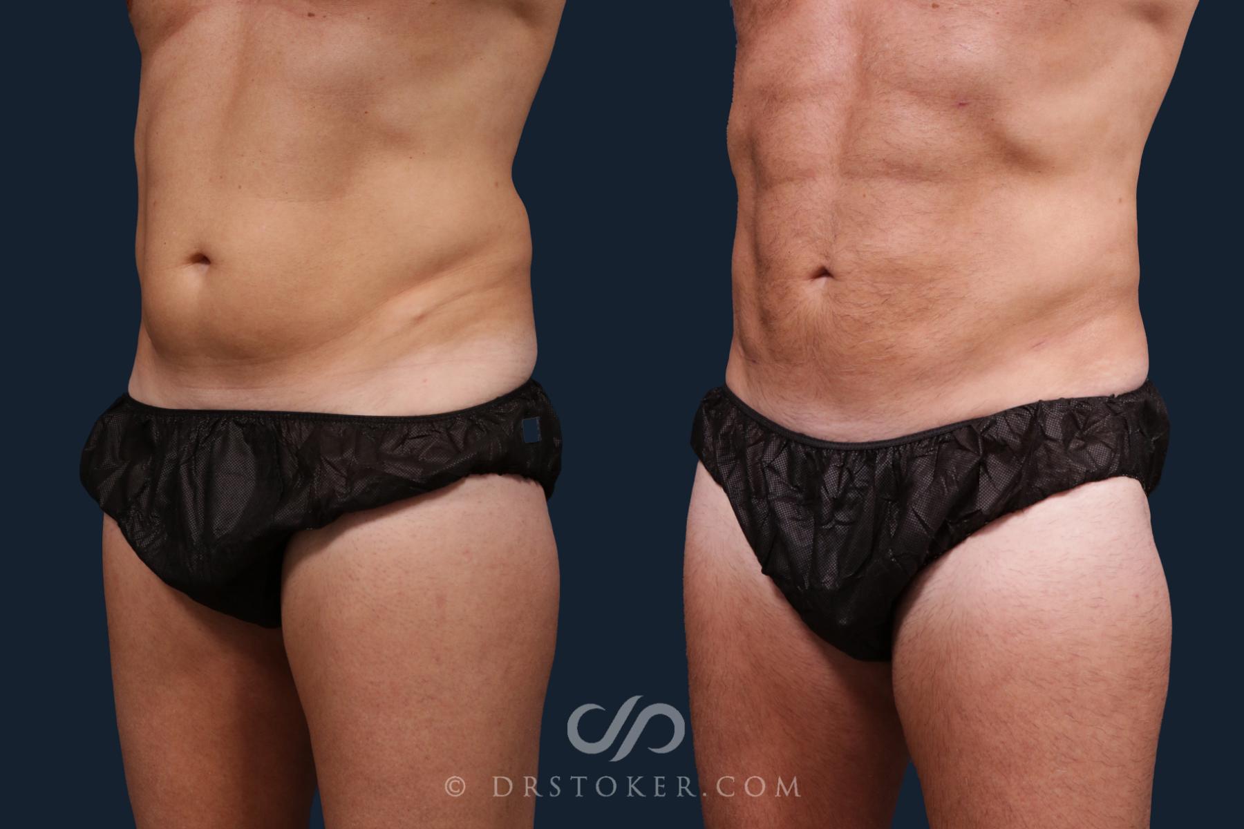 Before & After Abdominal Etching & Sculpting for Men Case 2179 Left Oblique View in Los Angeles, CA