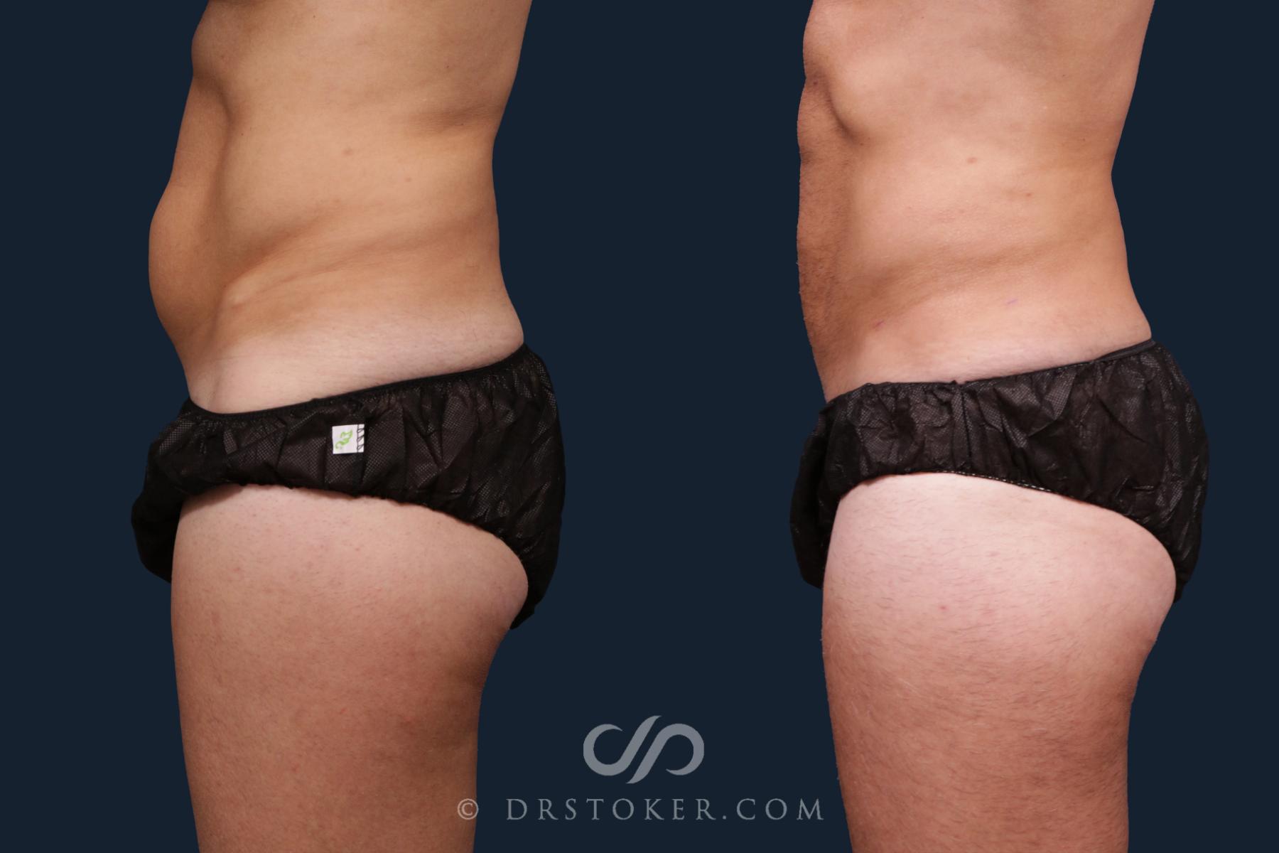 Before & After Abdominal Etching & Sculpting for Men Case 2179 Left Side View in Los Angeles, CA