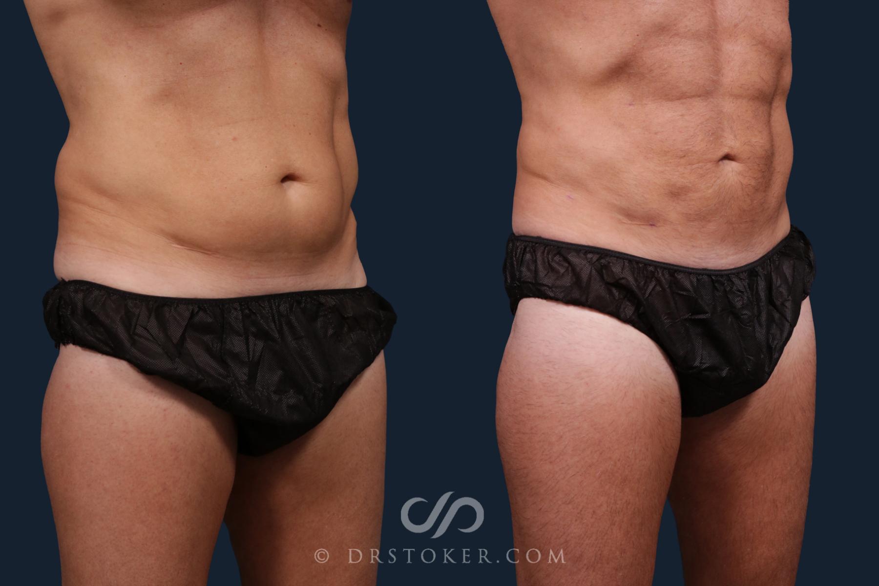 Before & After Abdominal Etching & Sculpting for Men Case 2179 Right Oblique View in Los Angeles, CA