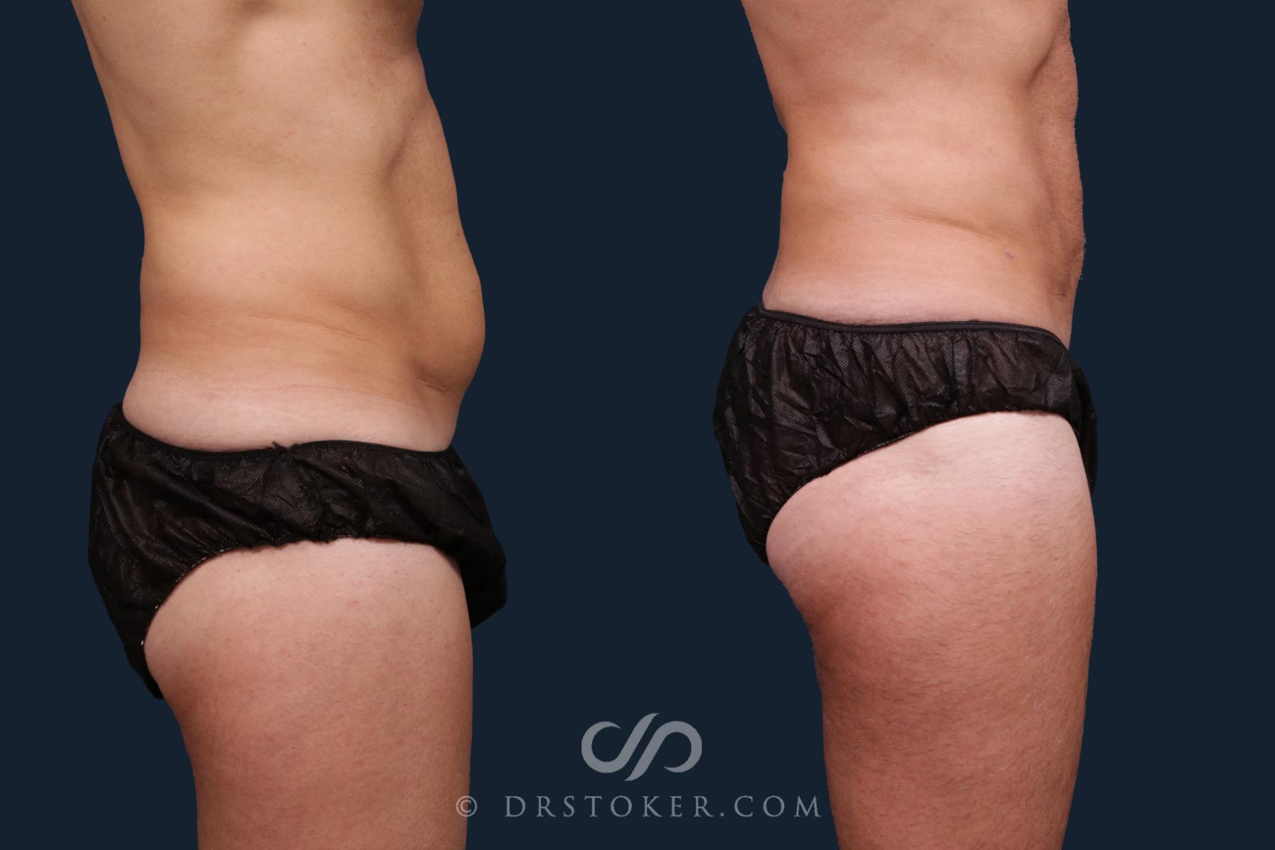 Before & After Abdominal Etching & Sculpting for Men Case 2179 Right Side View in Los Angeles, CA