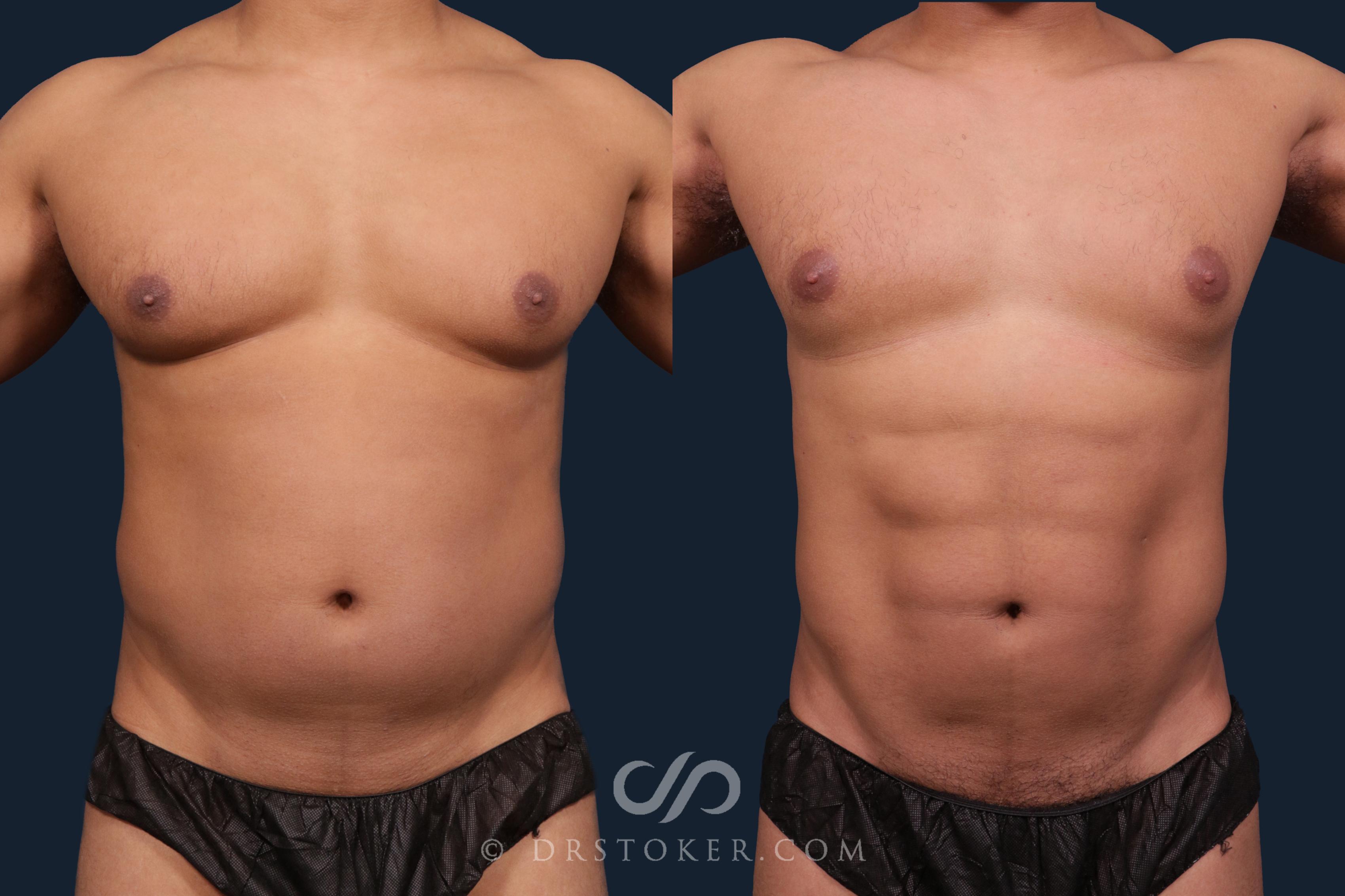 Before & After Abdominal Etching & Sculpting for Men Case 2195 Front View in Los Angeles, CA
