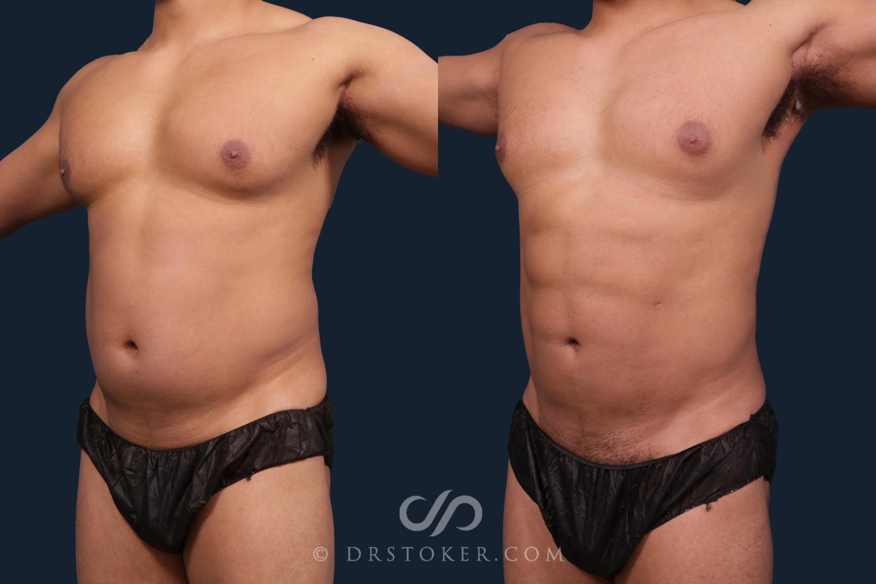 Before & After Abdominal Etching & Sculpting for Men Case 2195 Right Oblique View in Los Angeles, CA