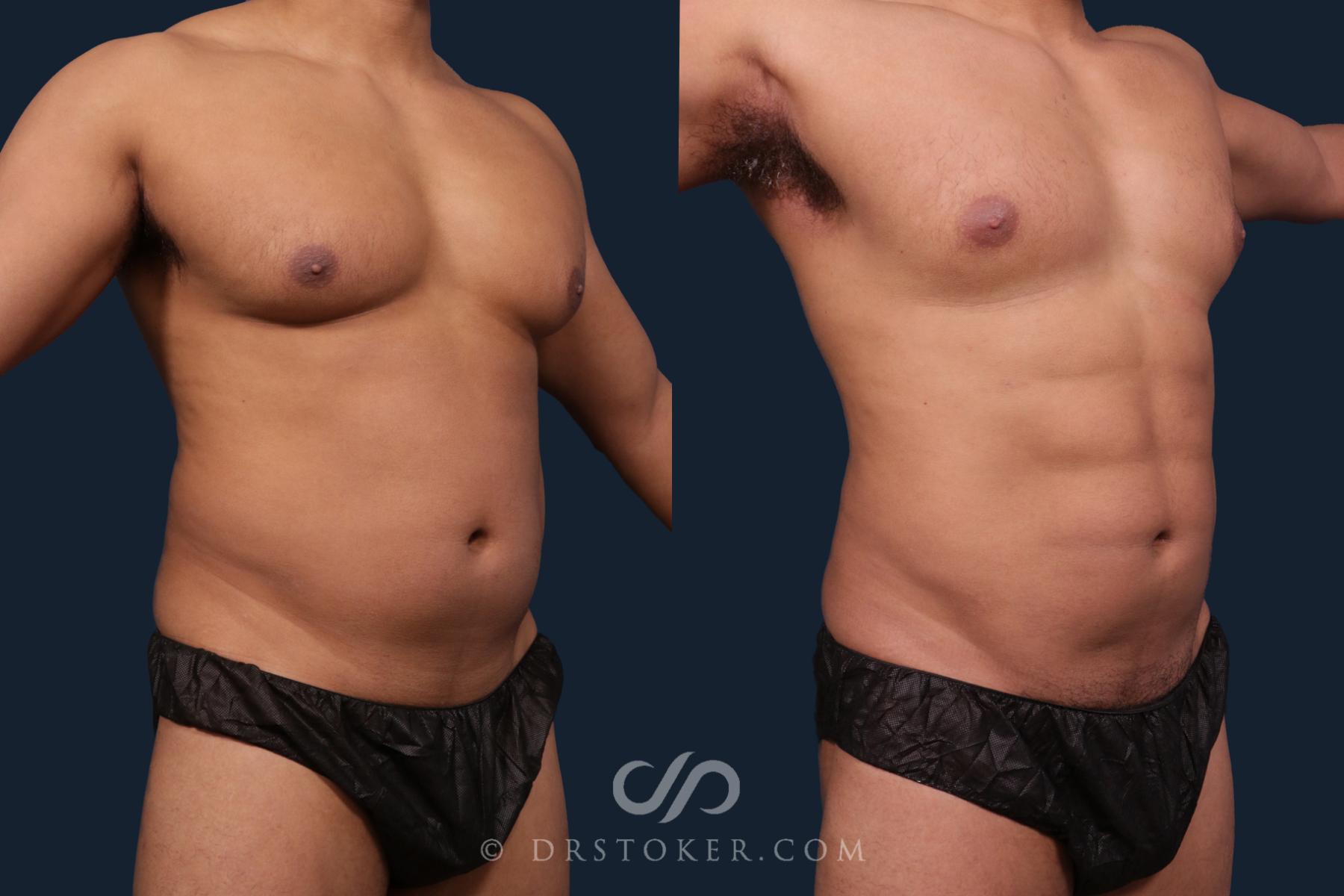 Before & After Abdominal Etching & Sculpting for Men Case 2196 Right Oblique View in Los Angeles, CA
