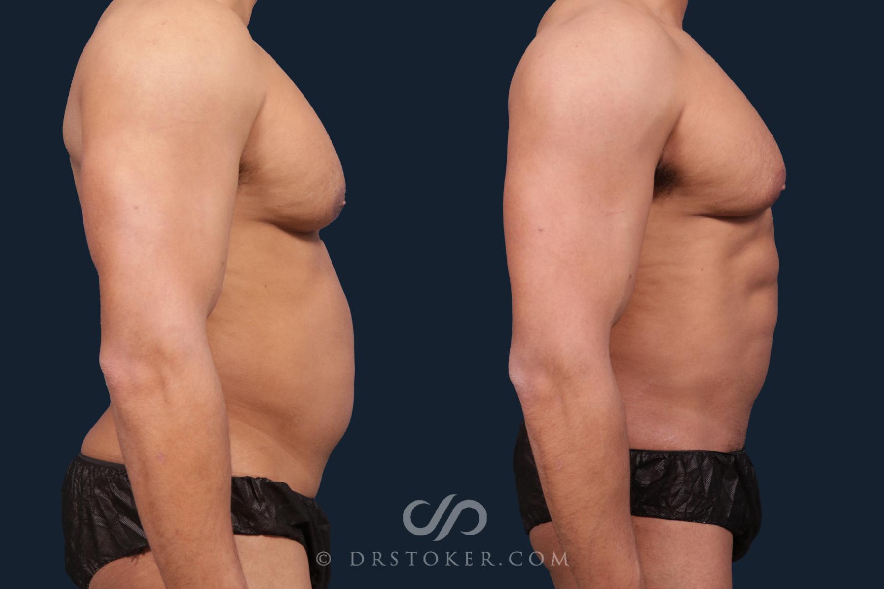 Before & After Abdominal Etching & Sculpting for Men Case 2196 Right Side View in Los Angeles, CA