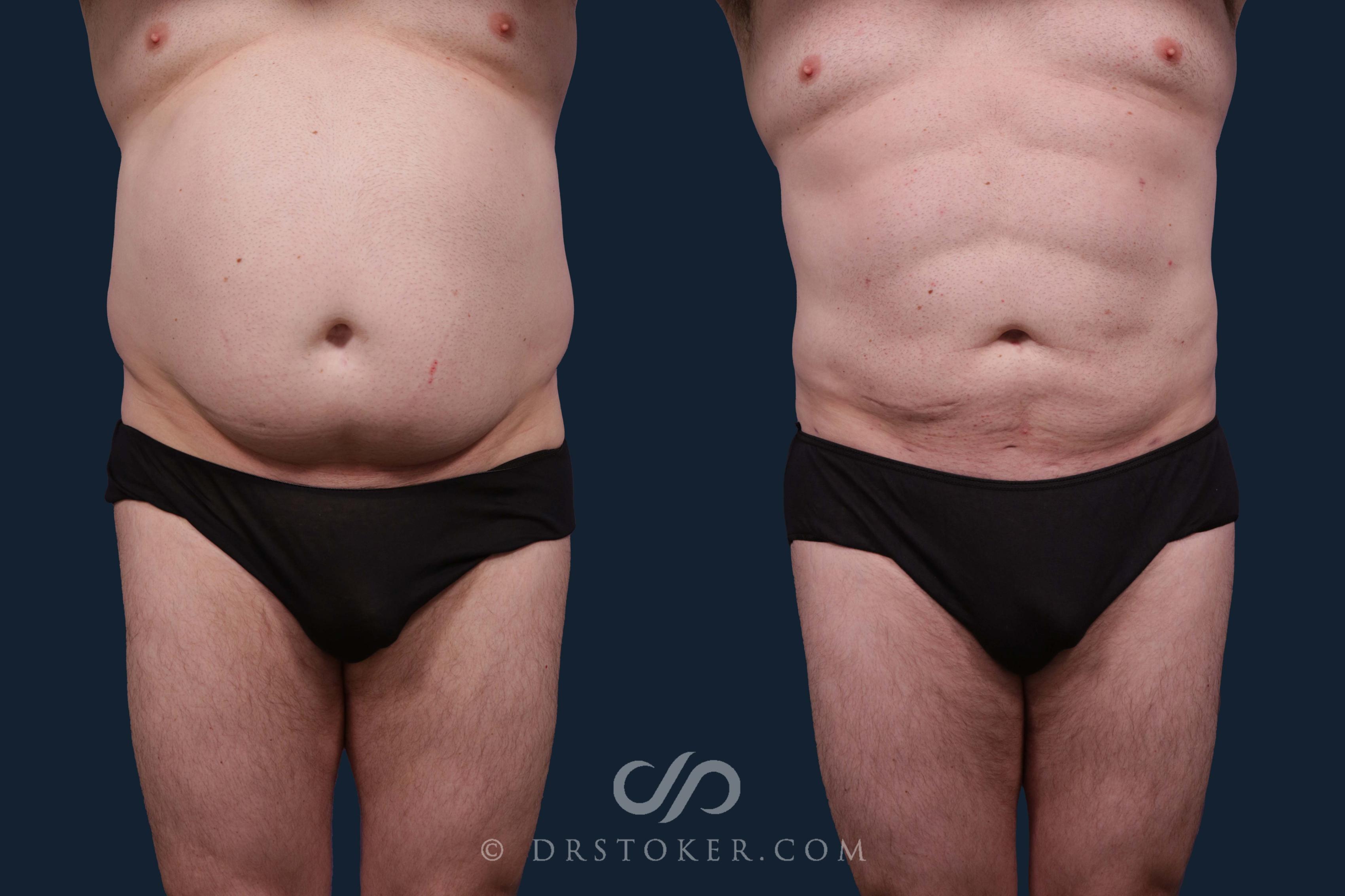 Before & After Abdominal Etching & Sculpting for Men Case 2203 Front View in Los Angeles, CA