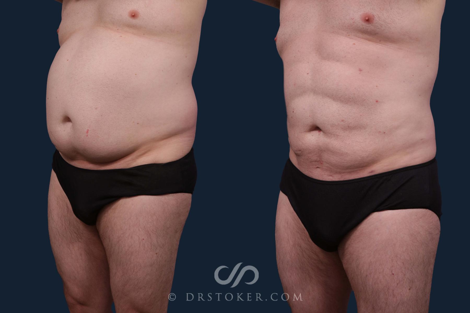 Before & After Abdominal Etching & Sculpting for Men Case 2203 Left Oblique View in Los Angeles, CA
