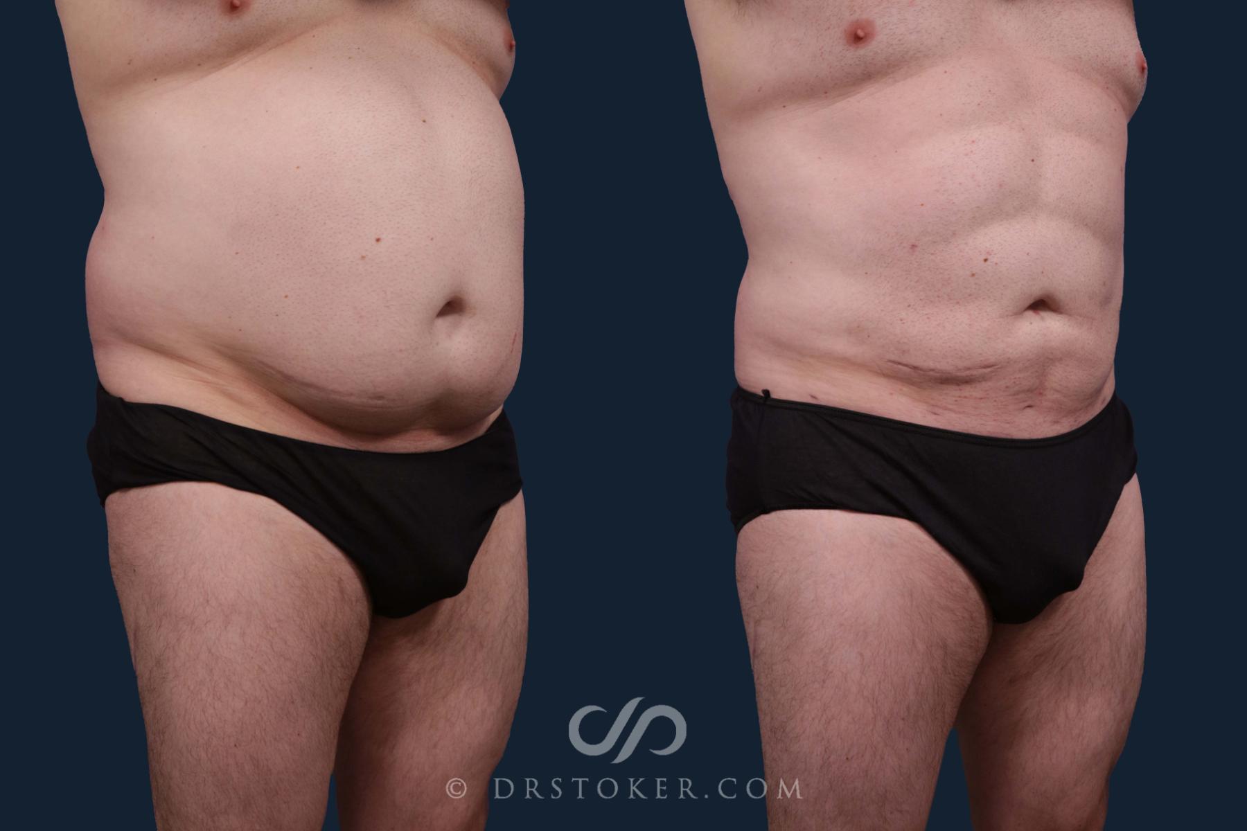 Before & After Abdominal Etching & Sculpting for Men Case 2203 Right Oblique View in Los Angeles, CA
