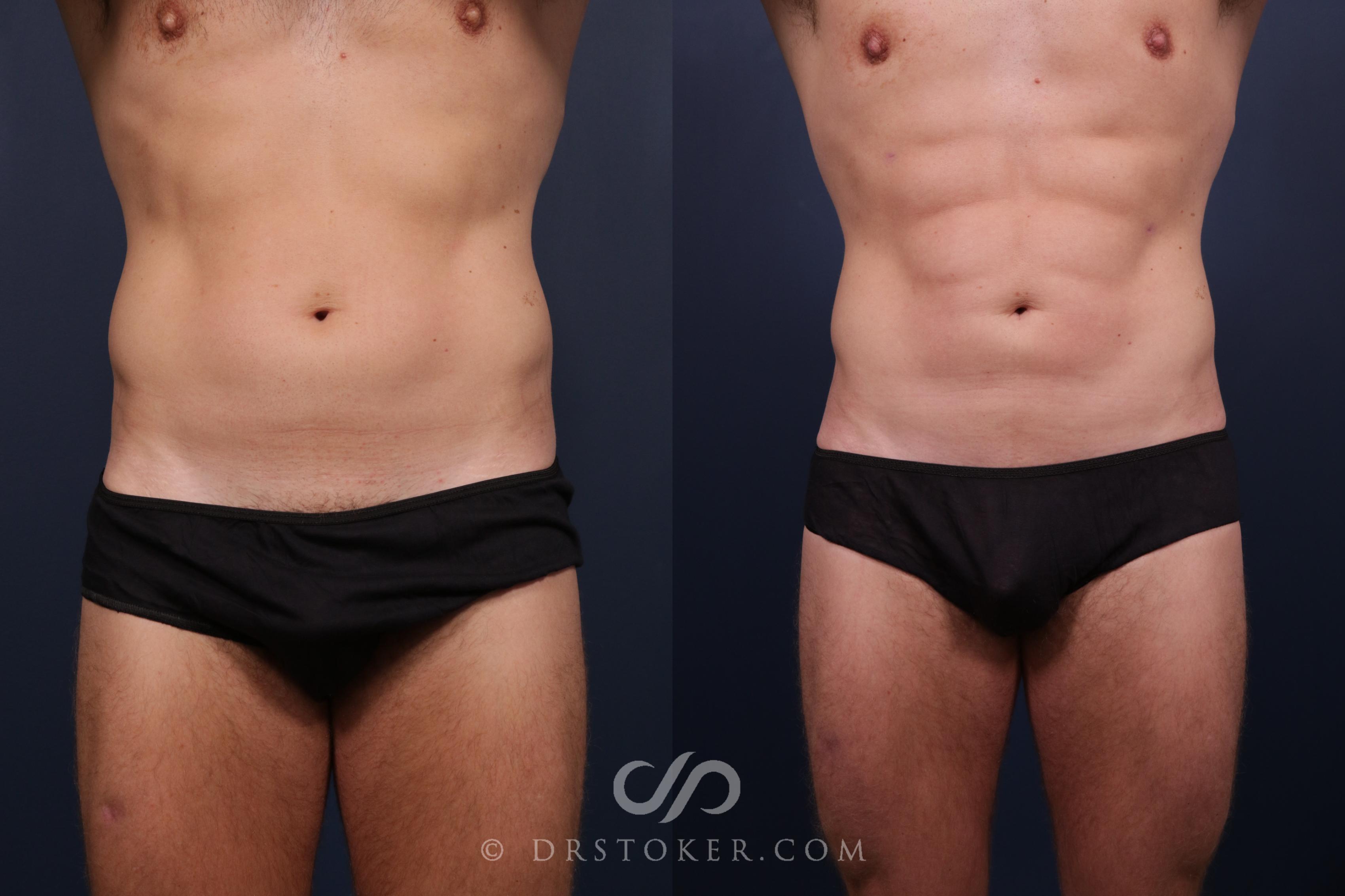Before & After Abdominal Etching & Sculpting for Men Case 2208 Front View in Los Angeles, CA