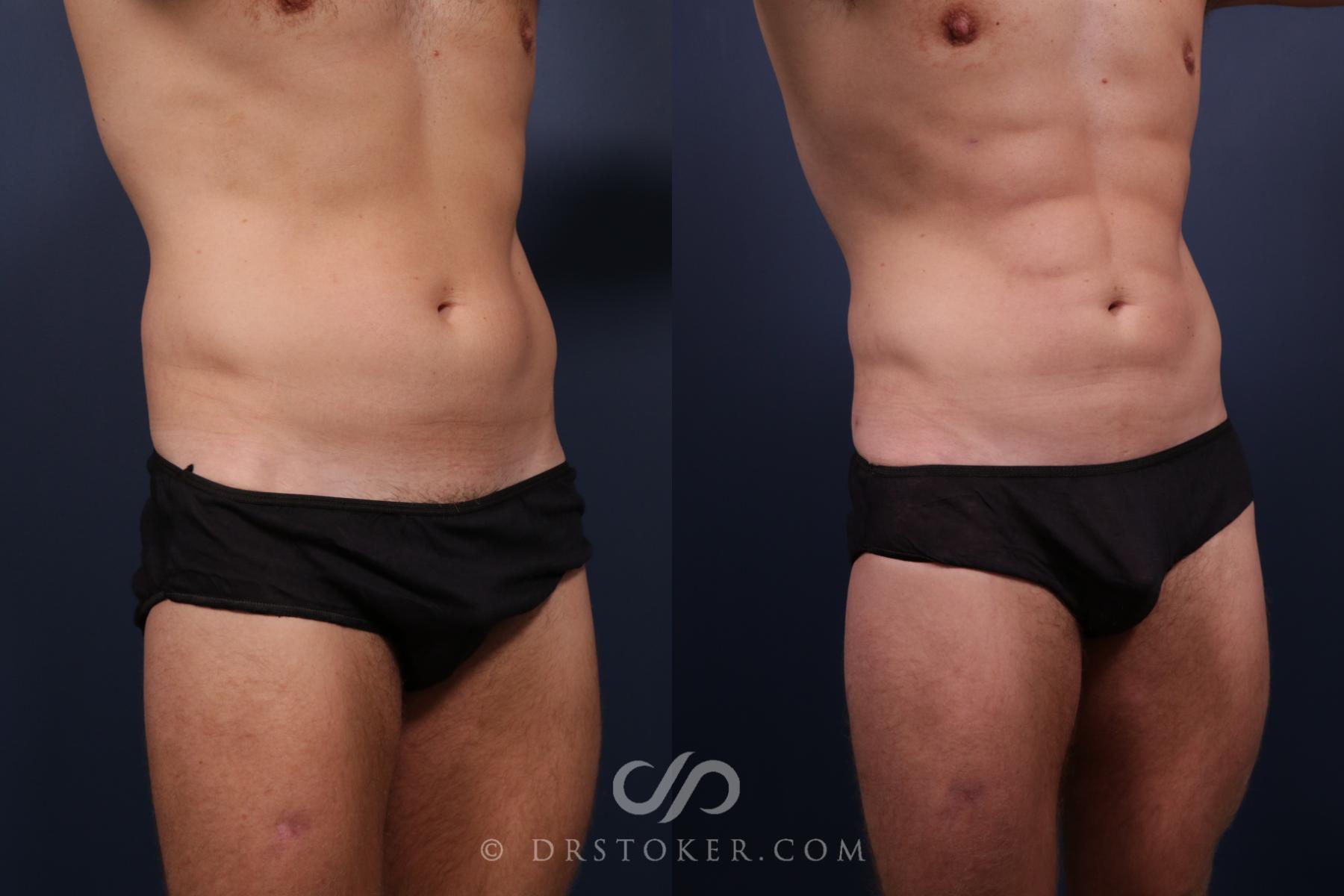 Before & After Abdominal Etching & Sculpting for Men Case 2208 Right Oblique View in Los Angeles, CA