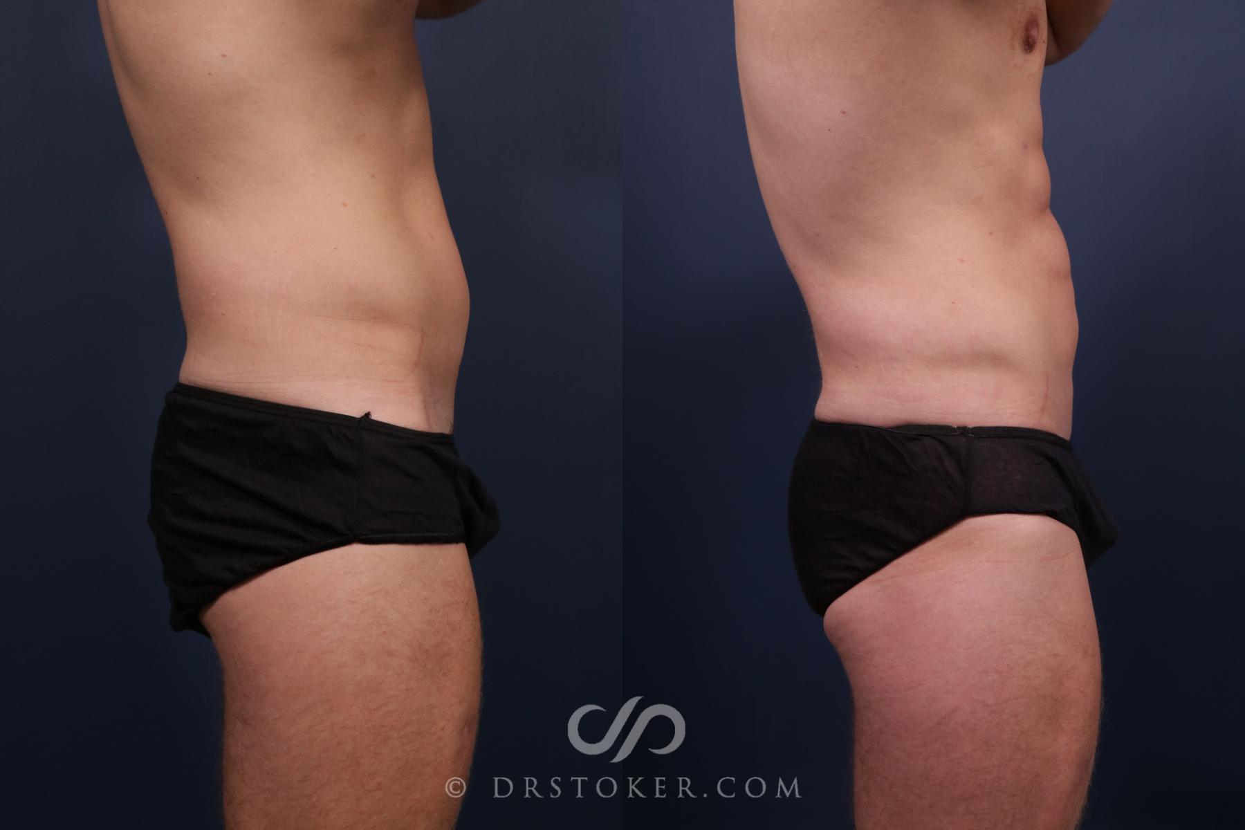 Before & After Liposuction Case 2208 Right Side View in Los Angeles, CA