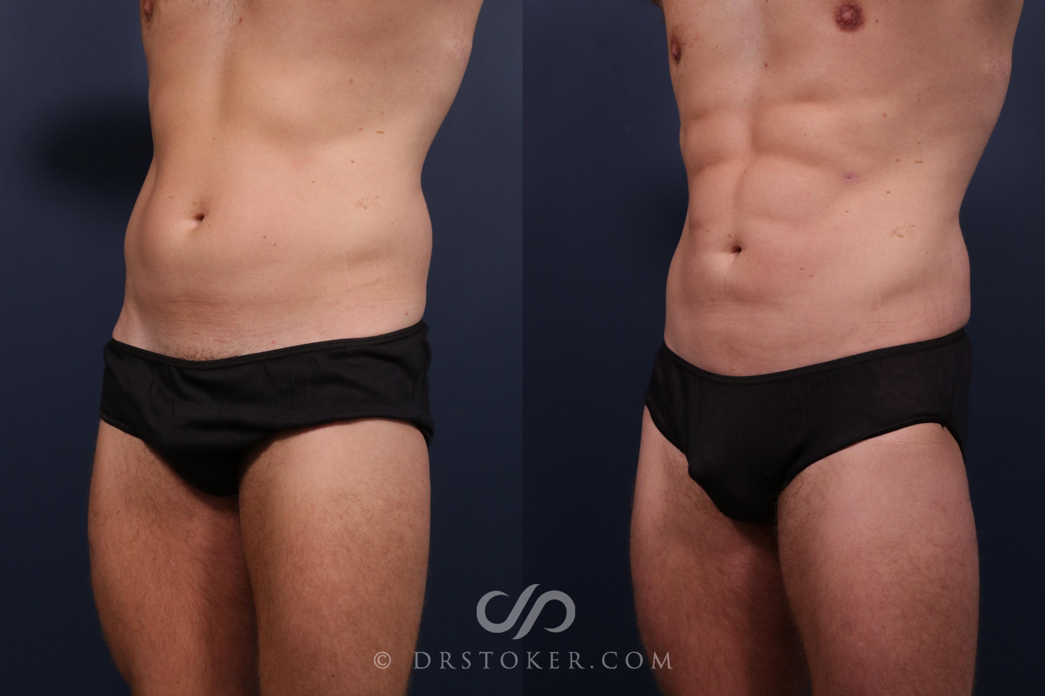 Before & After Abdominal Etching & Sculpting for Men Case 2209 Left Oblique View in Los Angeles, CA