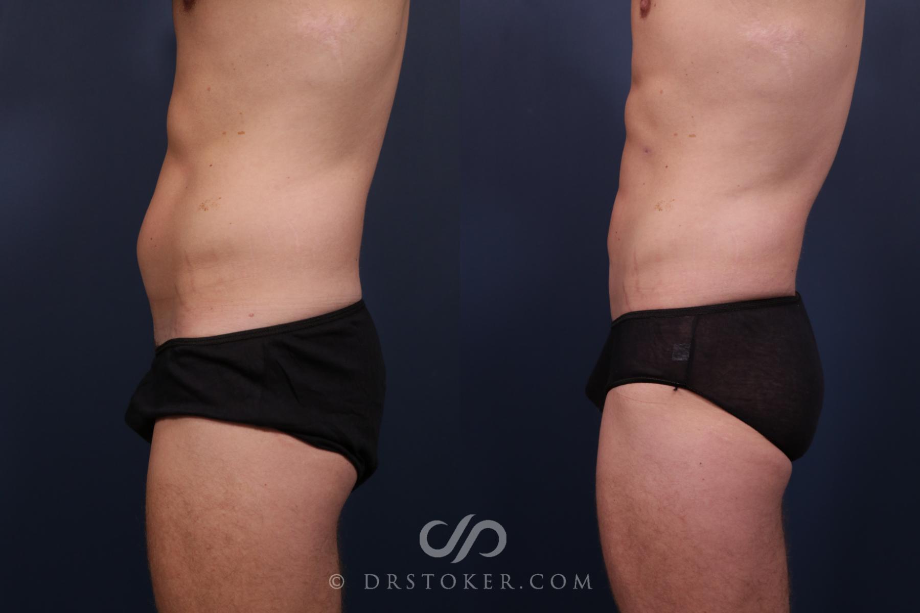 Before & After Liposuction - Abdominal Etching & Sculpting Case 2209 Left Side View in Los Angeles, CA