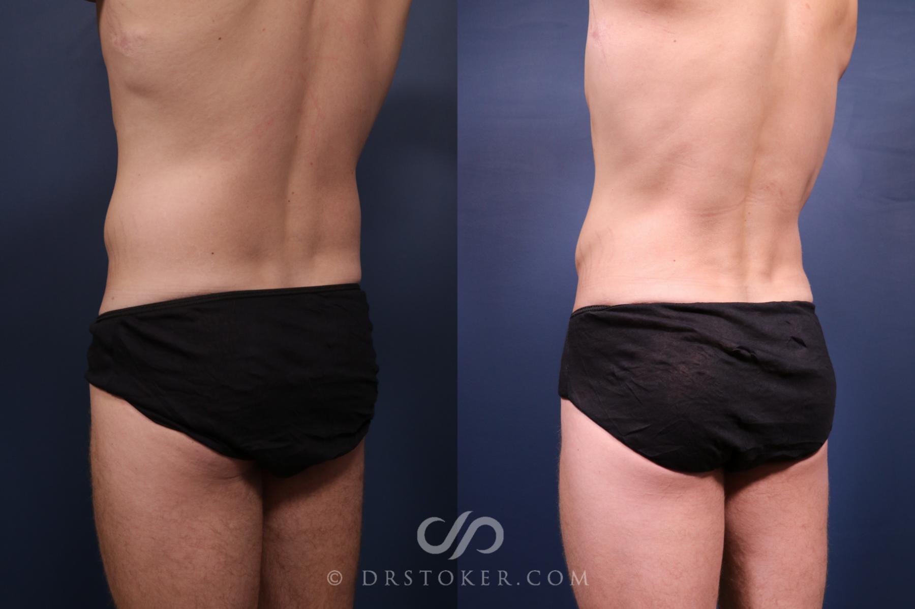 Before & After Abdominal Etching & Sculpting for Men Case 2659 Back Left Oblique View in Los Angeles, CA