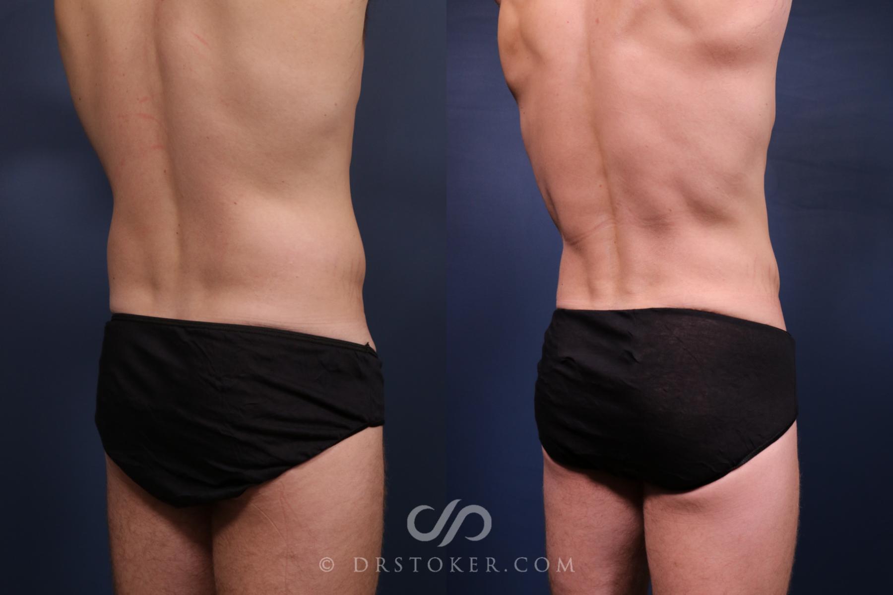 Before & After Abdominal Etching & Sculpting for Men Case 2659 Back Right Oblique View in Los Angeles, CA