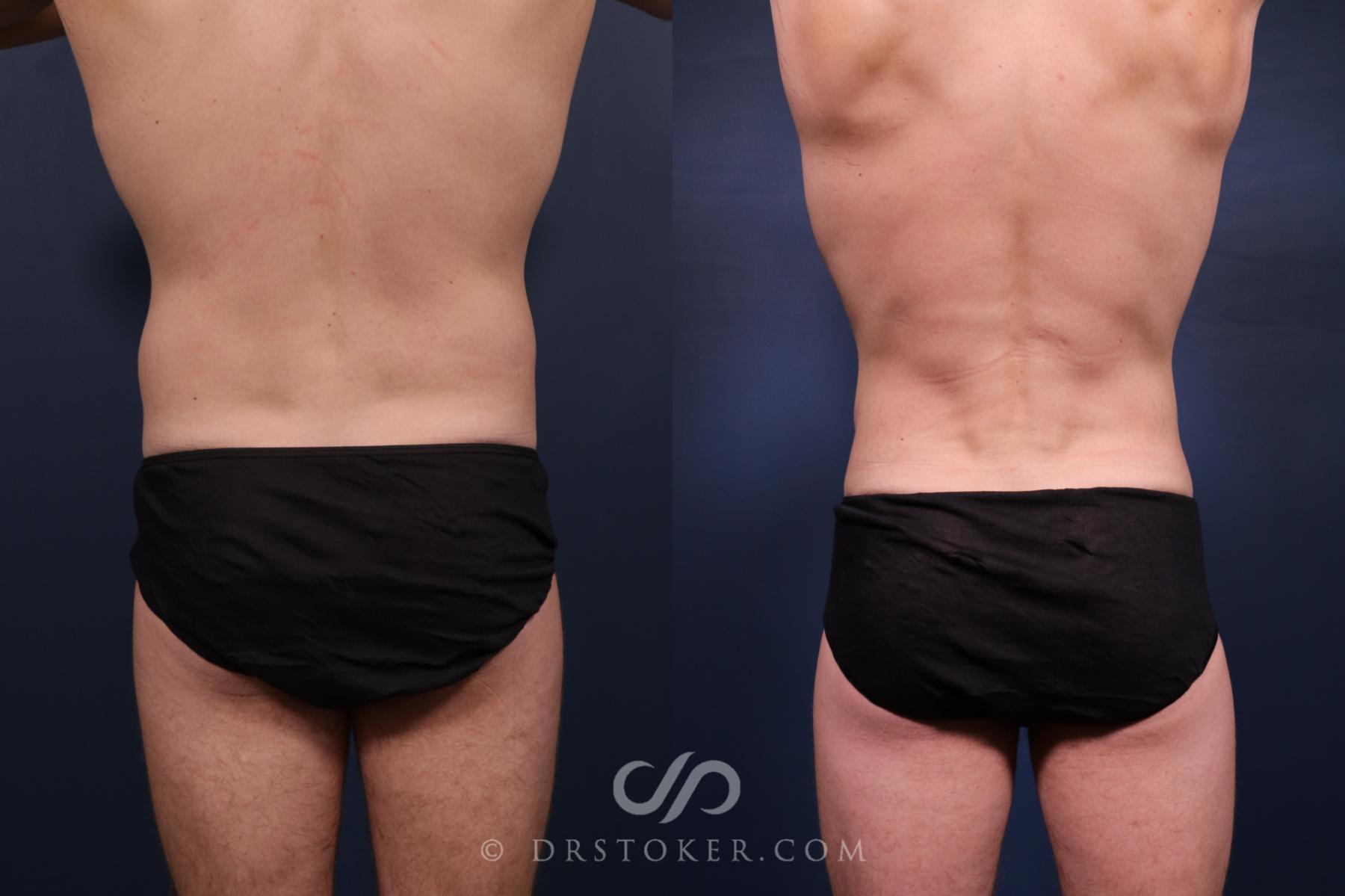 Before & After Abdominal Etching & Sculpting for Men Case 2659 Back View in Los Angeles, CA