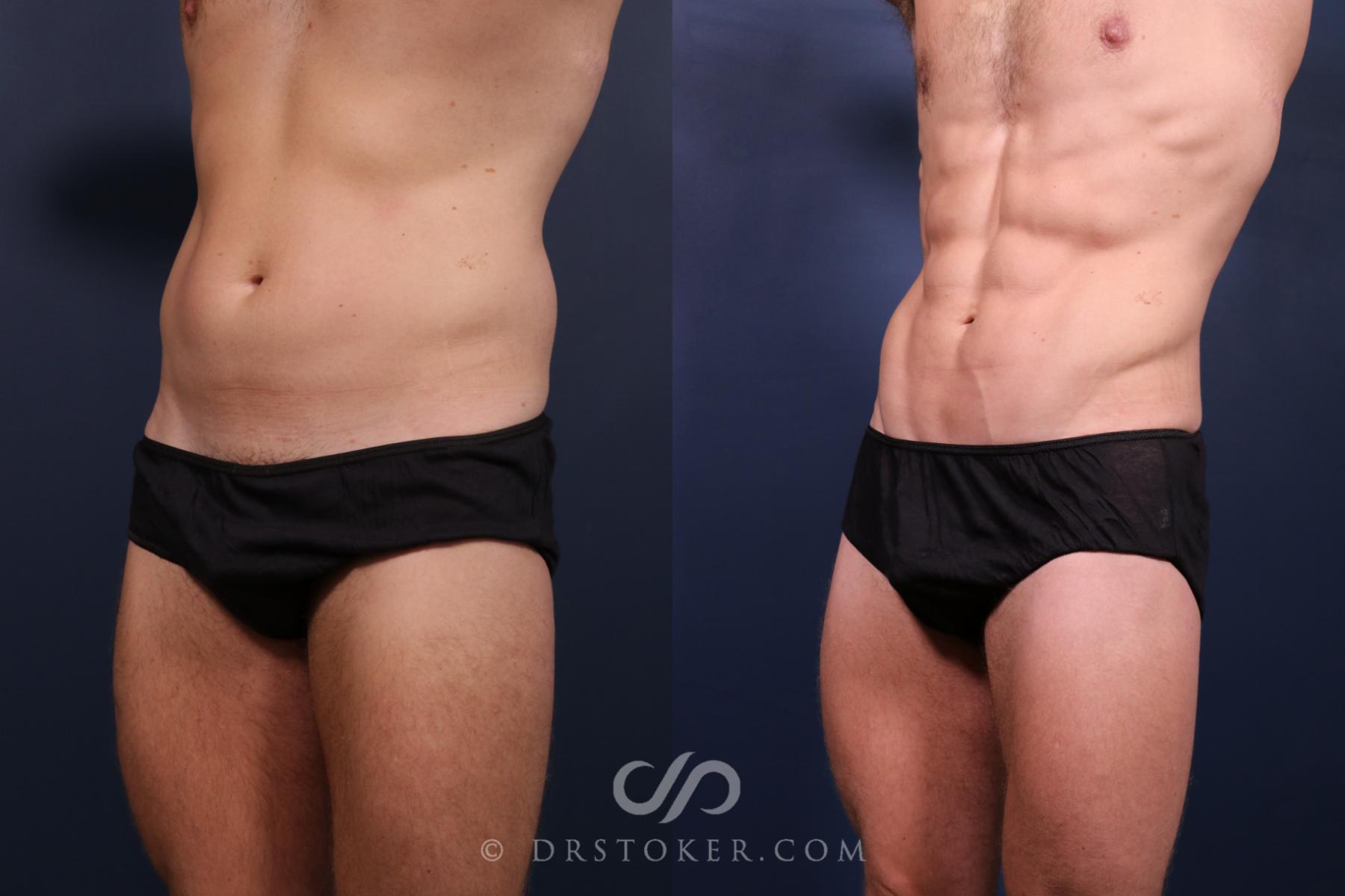 Before & After Abdominal Etching & Sculpting for Men Case 2659 Left Oblique View in Los Angeles, CA