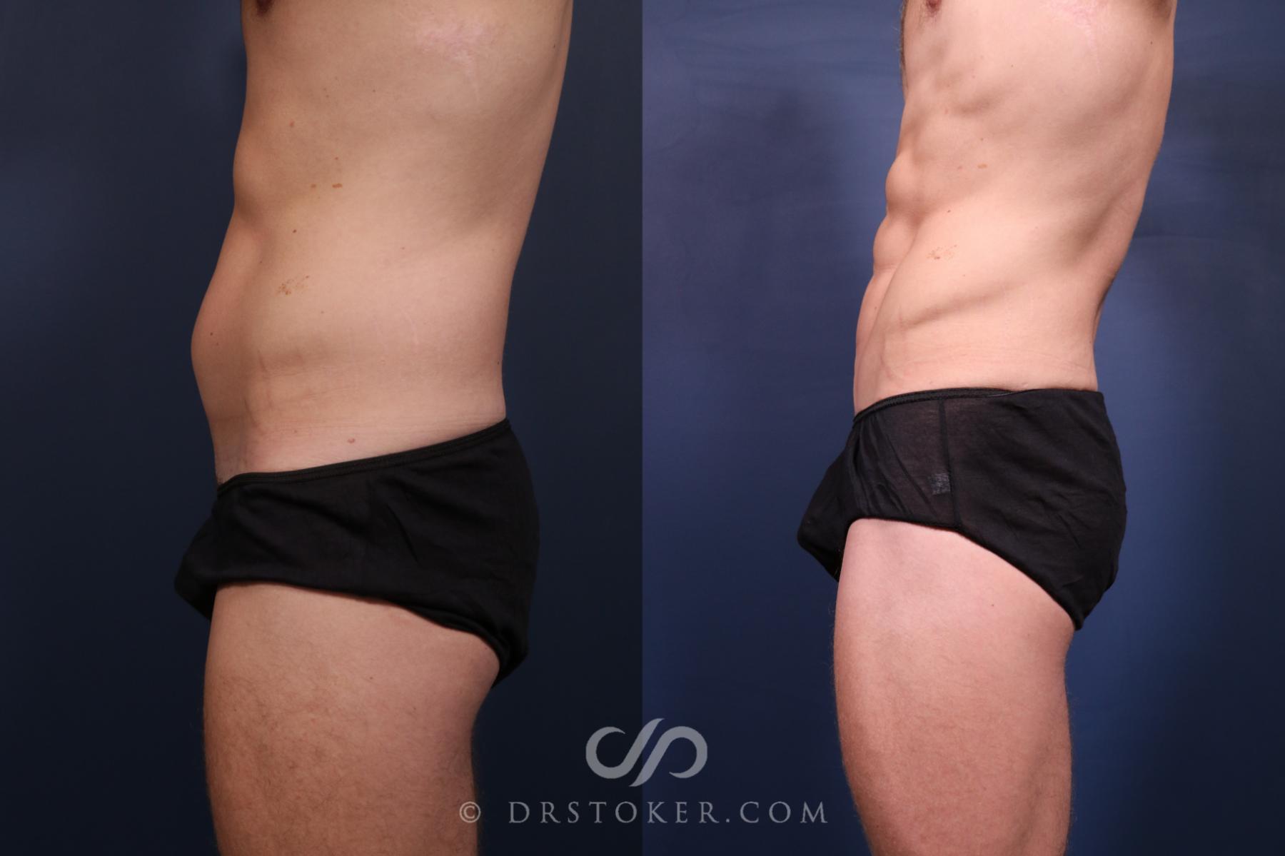 Before & After Abdominal Etching & Sculpting for Men Case 2659 Left Side View in Los Angeles, CA