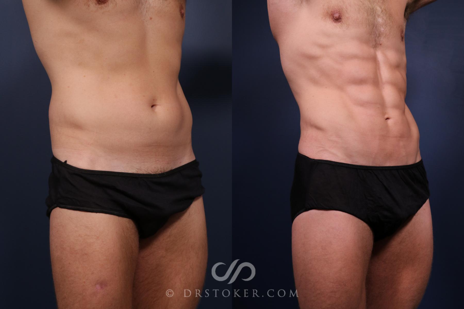 Before & After Abdominal Etching & Sculpting for Men Case 2659 Right Oblique View in Los Angeles, CA