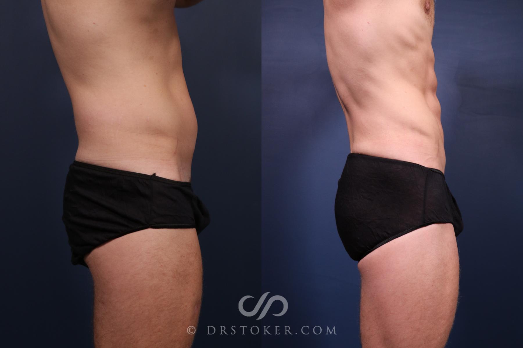 Before & After Abdominal Etching & Sculpting for Men Case 2659 Right Side View in Los Angeles, CA