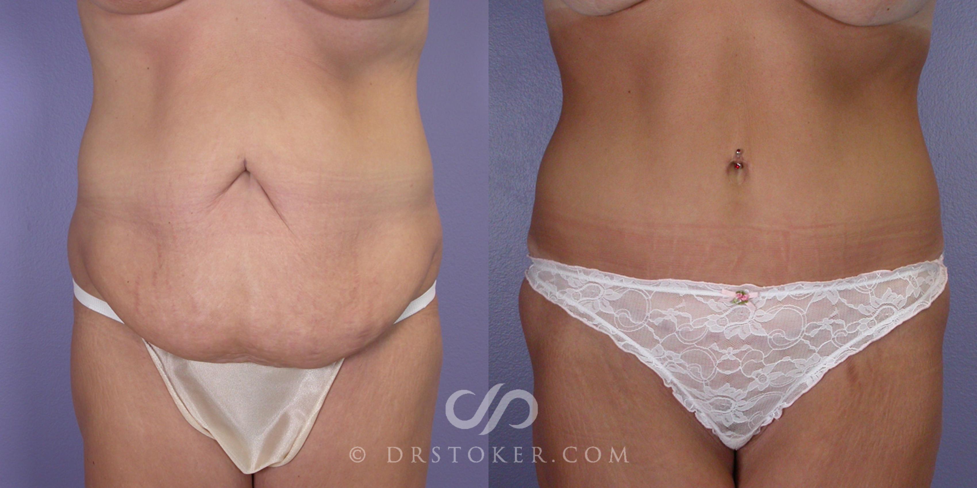 Before & After Tummy Tuck Case 104 View #1 View in Los Angeles, CA