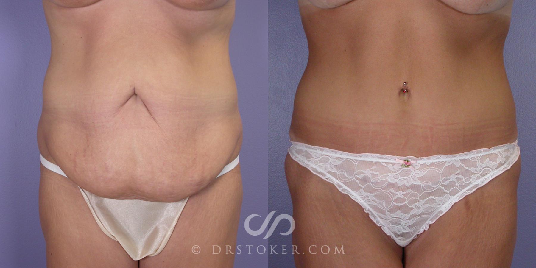 Before & After After Weight Loss Case 104 View #1 View in Los Angeles, CA