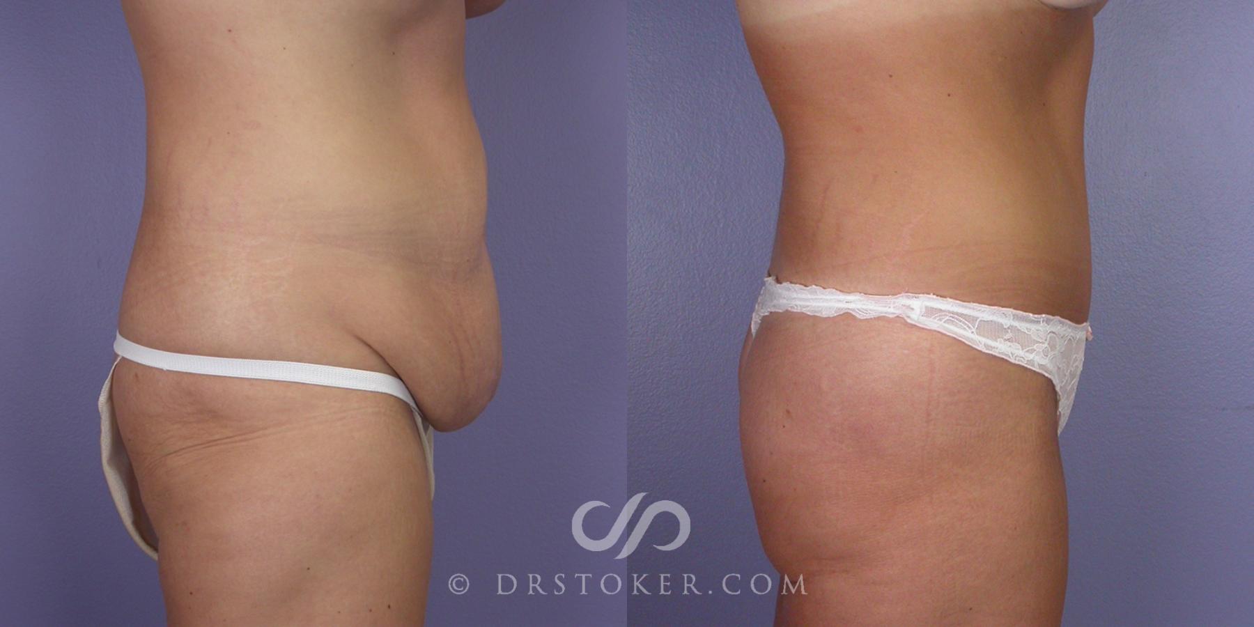 Before & After Tummy Tuck Case 104 View #2 View in Los Angeles, CA
